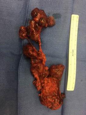 Fig. 29.2, Right lateral compartment neck dissection specimen of an 18-year-old with diffuse sclerosing variant papillary thyroid cancer (DSVPTC).