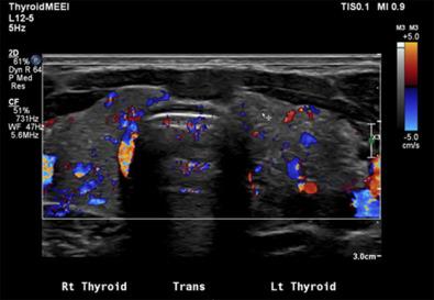 Fig. 29.3, Thyroid ultrasound (US) showing diffuse vascularity and microcalcifications in an 11-year-old girl with diffuse sclerosing variant papillary thyroid cancer (DSVPTC).