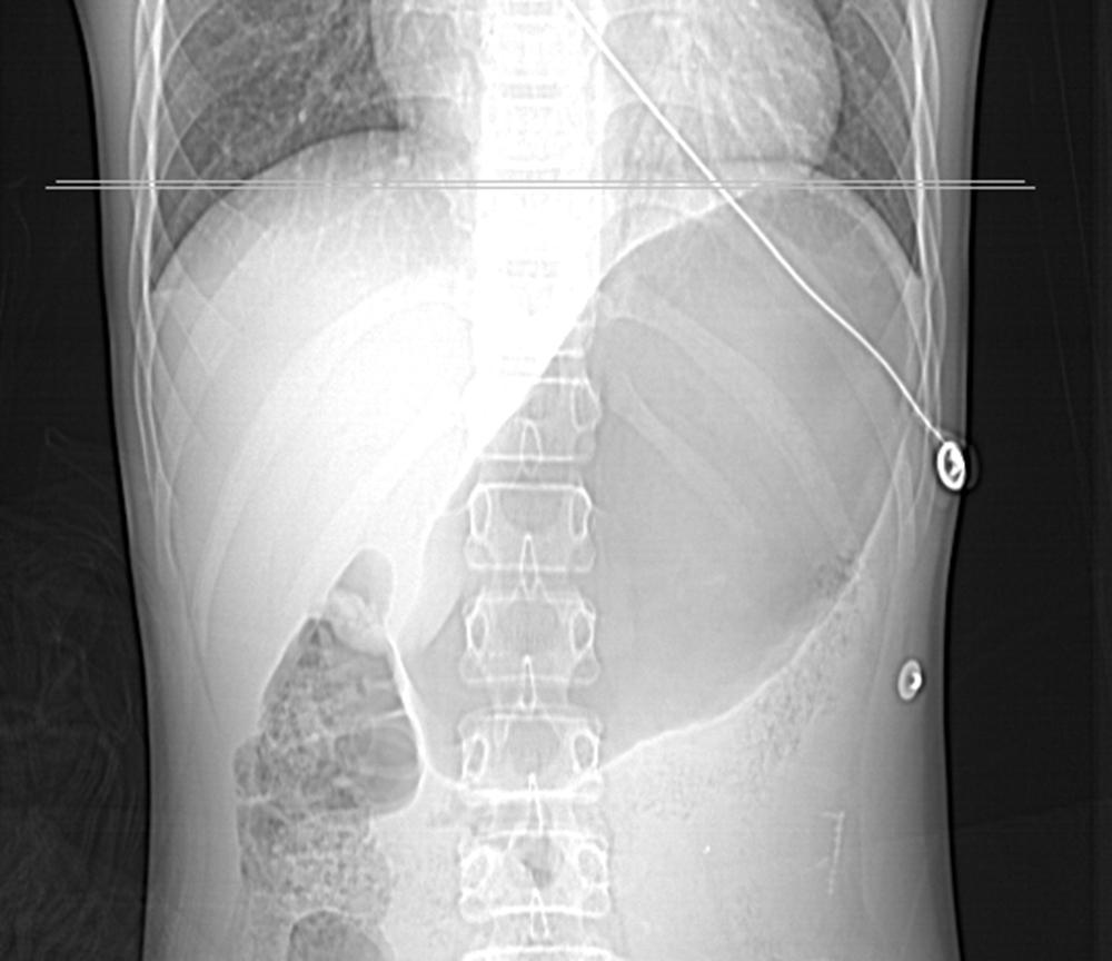 Fig. 160.1, CT (Scout) Demonstrating Gastric Distention in a Child Having Swallowed Large Amounts of Air from Crying. Severe Gastric Distention Can Harm Diaphragmatic Excursion and Impact Ventilation.