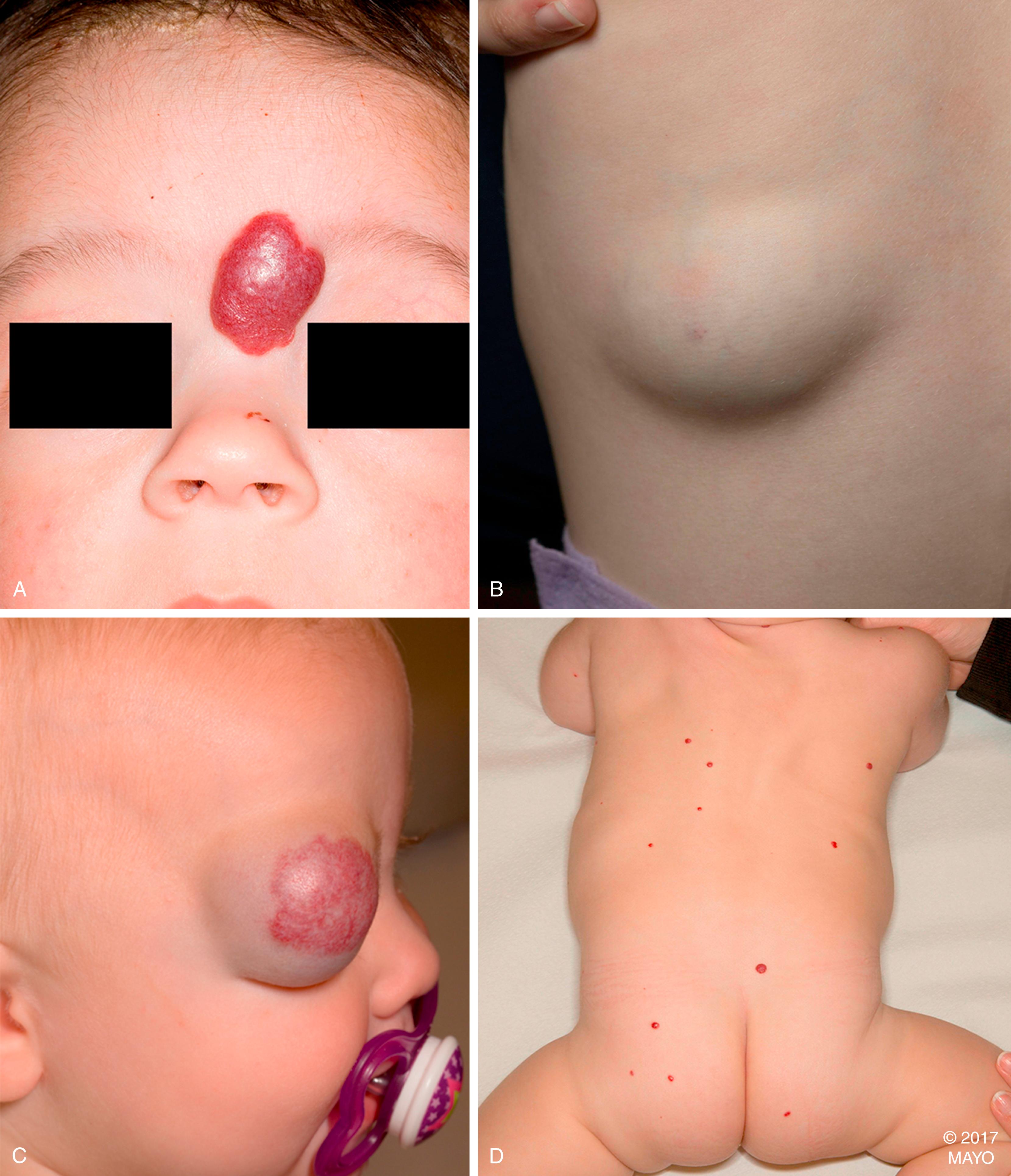 Figure 187.1, Various Types of Infantile Hemangioma.