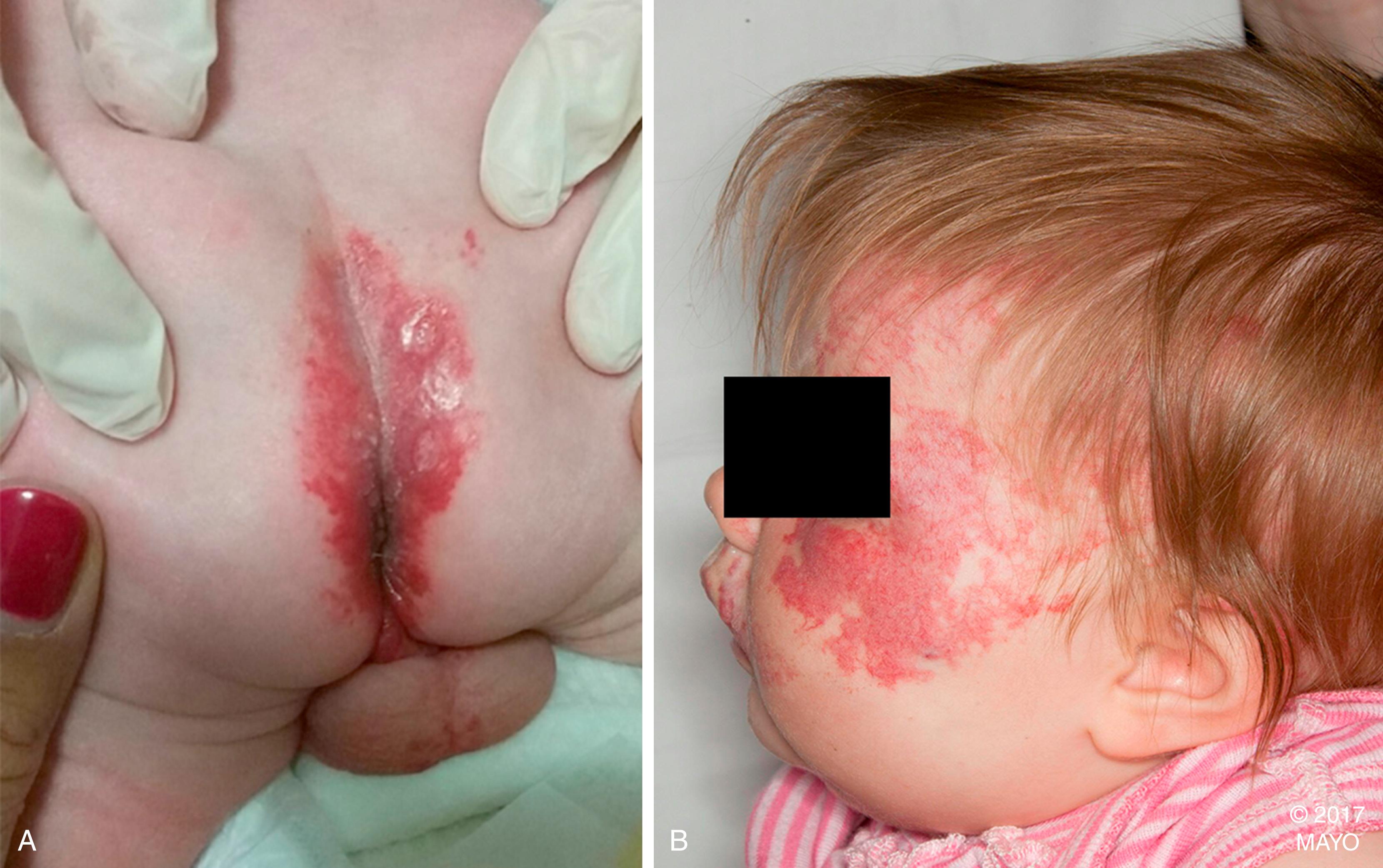 Figure 187.2, Segmental lumbosacral ( A ) and facial ( B ) infantile hemangiomas. Such findings should raise suspicion of LUMBAR or PHACE associations.