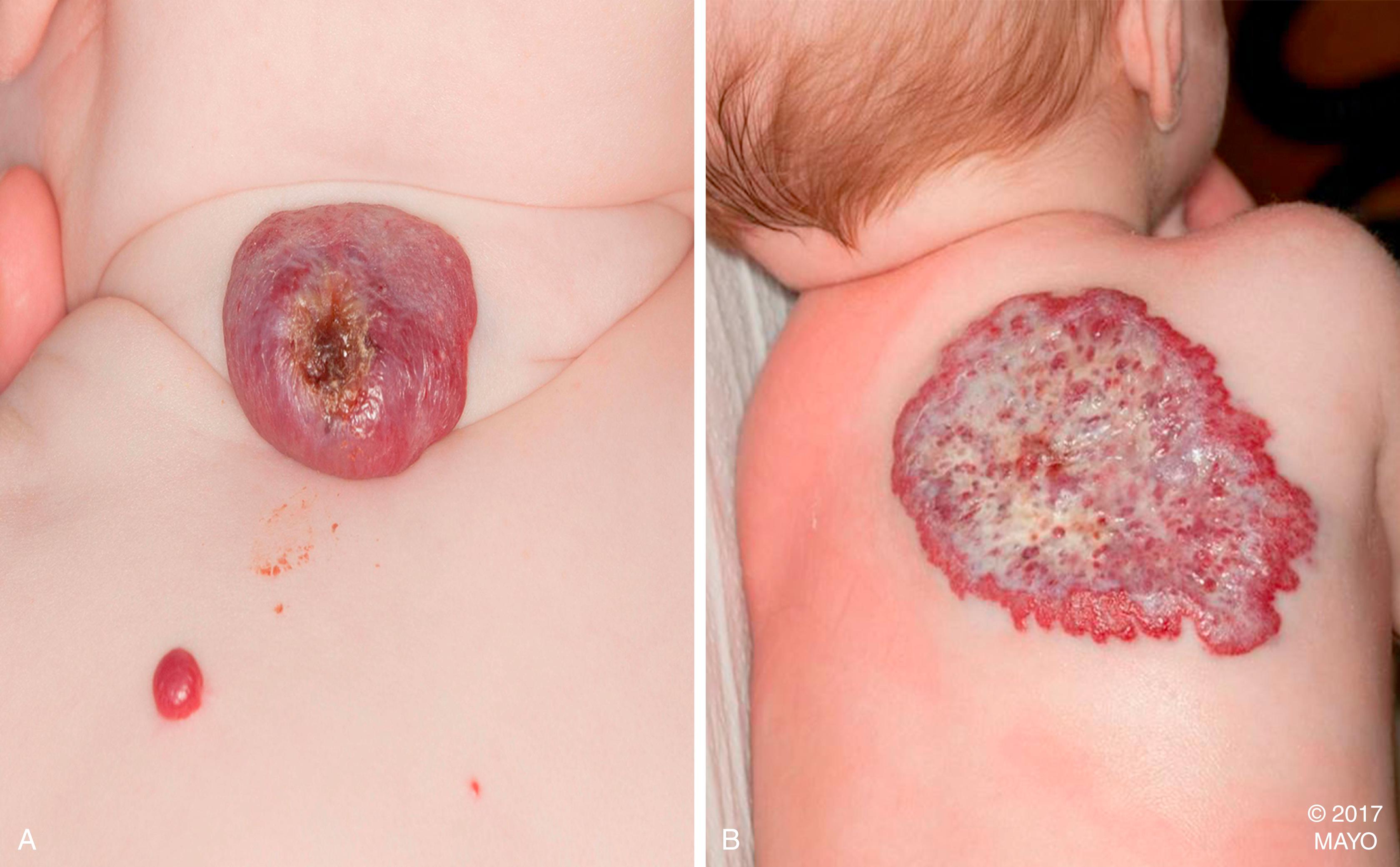 Figure 187.3, Images of ulcerative infantile hemangioma on the neck ( A ) and upper back ( B ).