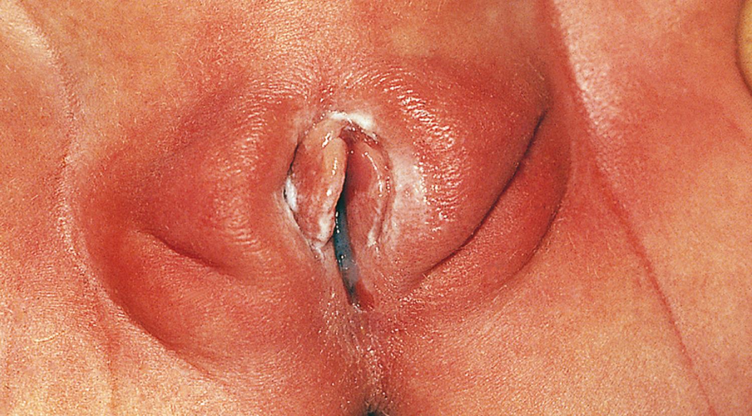 Fig. 19.1, Normal appearance of the genitalia in a newborn. The labia majora are full, and the thickened labia minora protrude between them. The mucosa is pink, and a milky white discharge is seen, reflecting stimulation by maternal hormones.