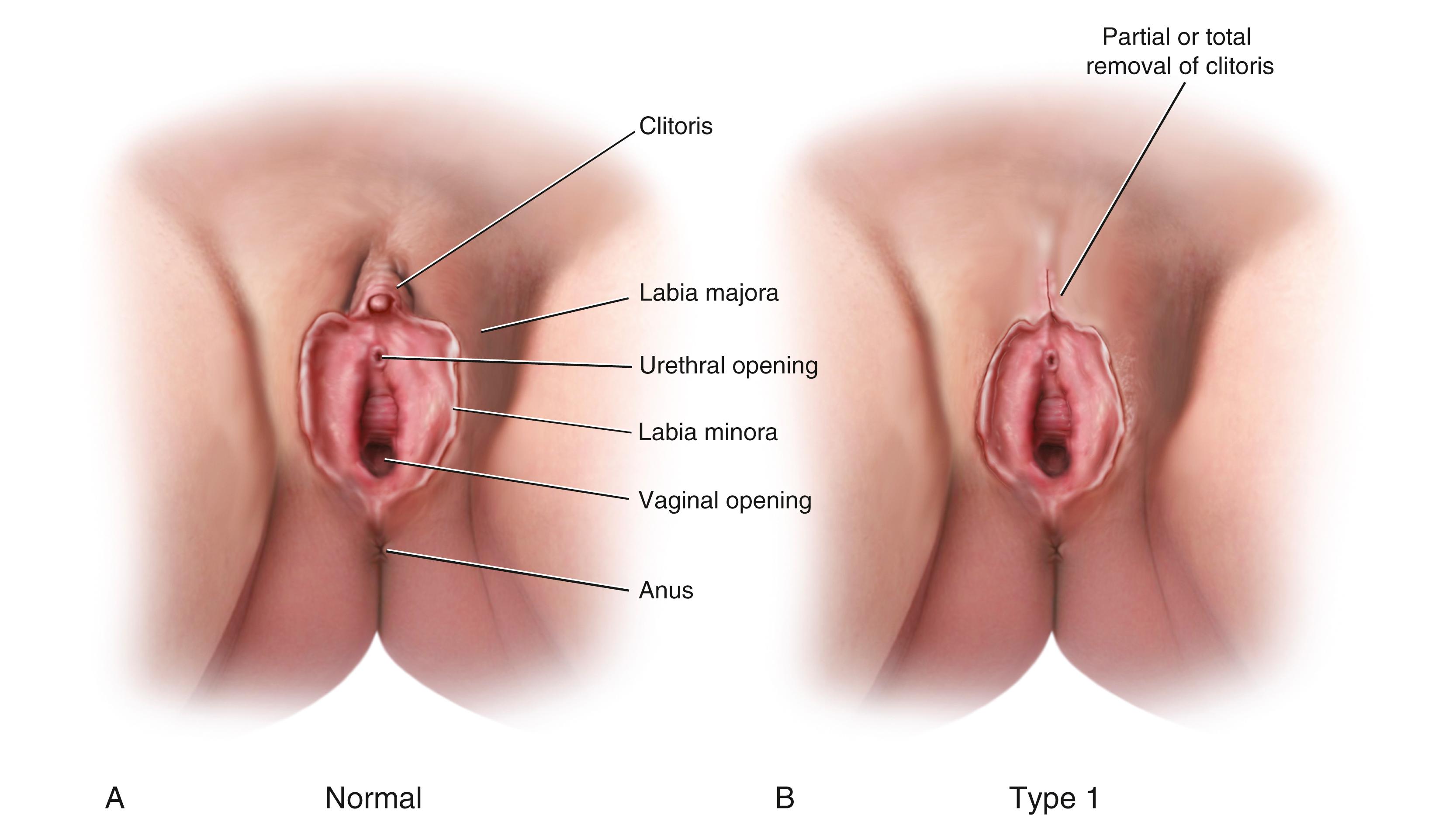 Fig. 19.11, Female genital mutilation/cutting (FGM/C) is classified into four types. (A) Normal female genital anatomy. (B) Type 1 “clitoridectomy” involves partial or total removal of the clitoris and/or the skin around it. (C) Type 2 removal of the clitoris and labia minora. (D) Type 3 removal of the clitoris and labia minora, and labia majora sewn together to cover urethral opening and most of the vaginal opening. Type 4 involves all other alterations, including pricking, piercing, incising, or cauterizing the genitalia.