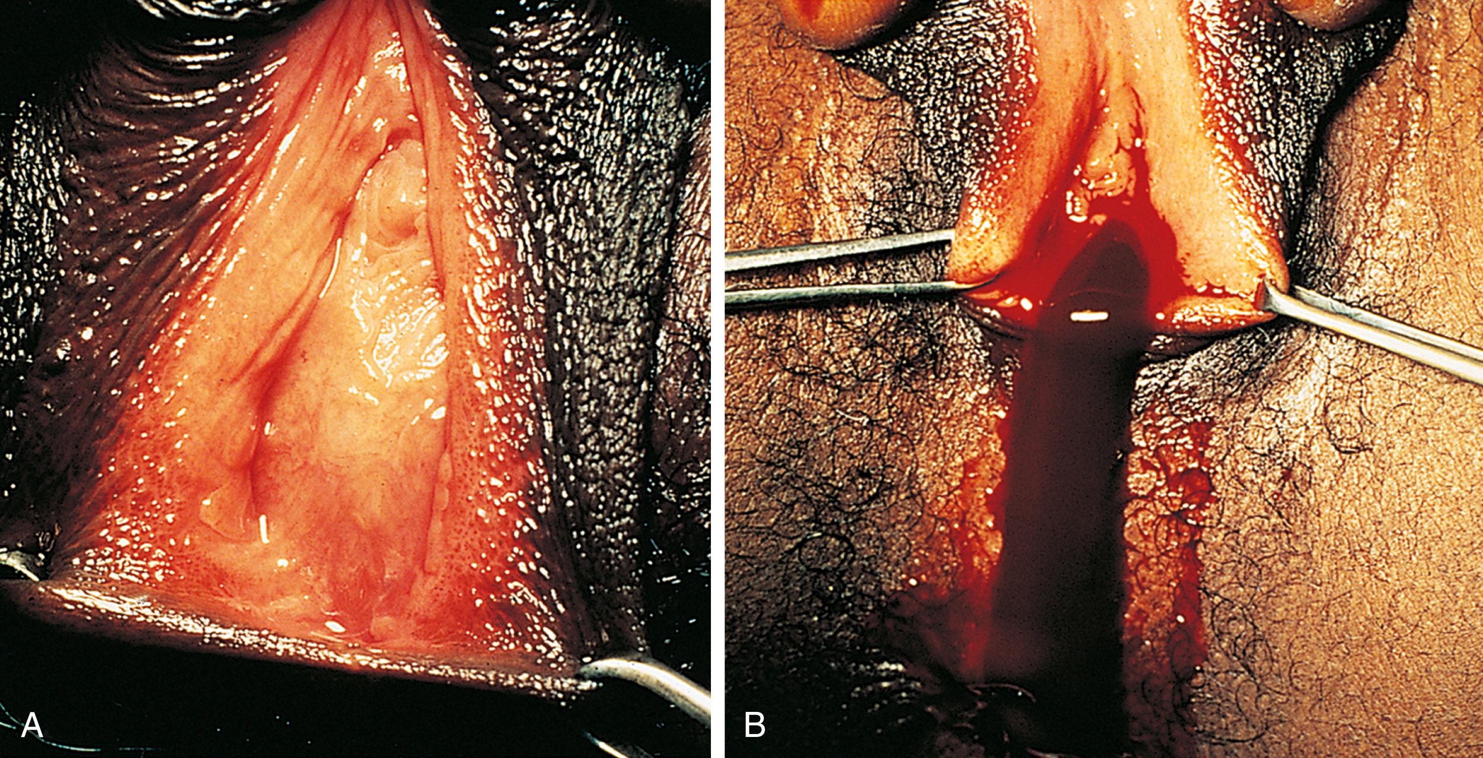 Fig. 19.13, Imperforate hymen with hematocolpos. This adolescent presented with a 2-month history of intermittent crampy lower abdominal pain, which had acutely worsened. She had well-developed secondary sex characteristics but was premenarchal by history. (A) Examination revealed midline fullness and tenderness of the lower abdomen and a smooth bulging mass at the introitus. (B) Incision of the imperforate membrane just inside the hymenal ring allowed the accumulated menstrual blood and vaginal secretions to drain.