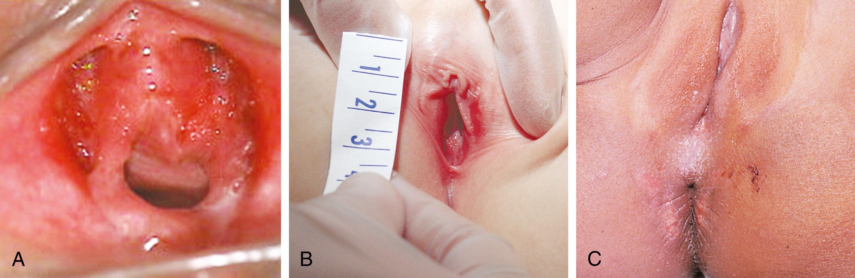 Fig. 19.14, Superficial blunt trauma. (A) Superficial abrasions and bruising are seen anteriorly on either side of the clitoris and urethra in a 3-year-old who presented with dysuria. (B) In another toddler, a superficial abrasion/laceration is seen between the left labia minora and majora after a straddle injury. (C) These healing superficial abrasions involving the posterior fourchette and perianal area were the result of sexual abuse.