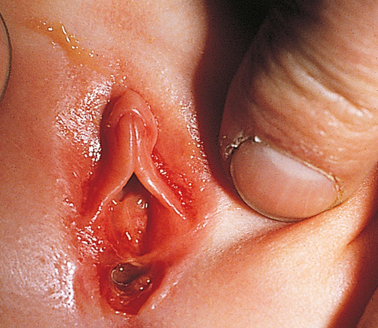 Fig. 19.15, Superficial penetrating injury. This infant had a chief complaint of blood spotting on the diaper. Inspection revealed a perineal tear just posterior to the hymenal ring. There was no evidence of internal extension on vaginoscopy under anesthesia. Sexual abuse was suspected.