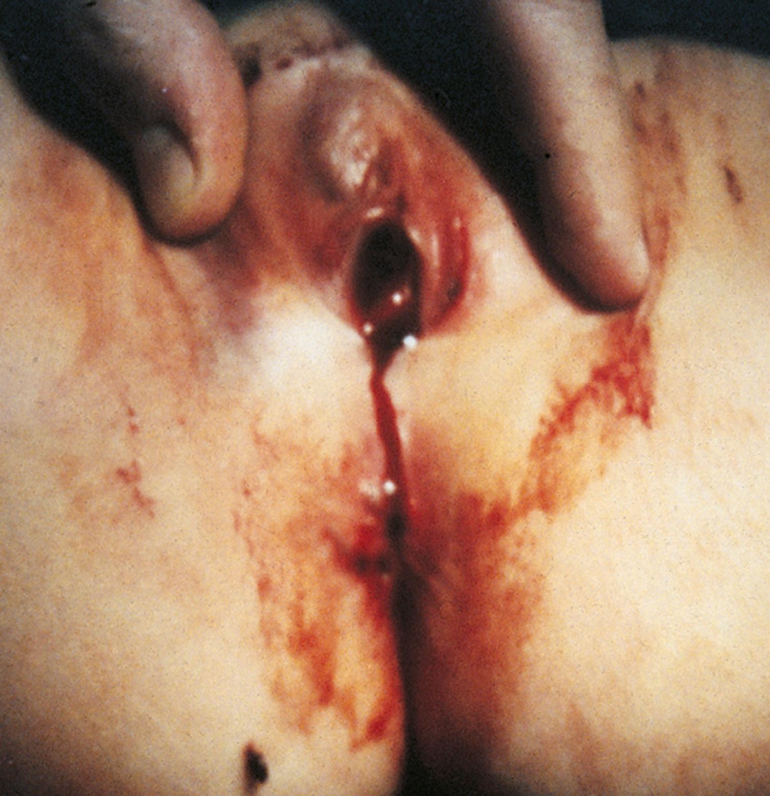 Fig. 19.16, Moderate genital trauma. After a straddle injury on a diving board, this 9-year-old girl had vaginal bleeding. Inspection disclosed a hematoma of the anterior portion of the right labia majora, contusions of the clitoris and anterior labia minora, and a hematoma protruding through the vaginal opening. A small superficial laceration is present on the left, between the labia majora and minora. At vaginoscopy under anesthesia a vaginal tear involving the right lateral wall was found.