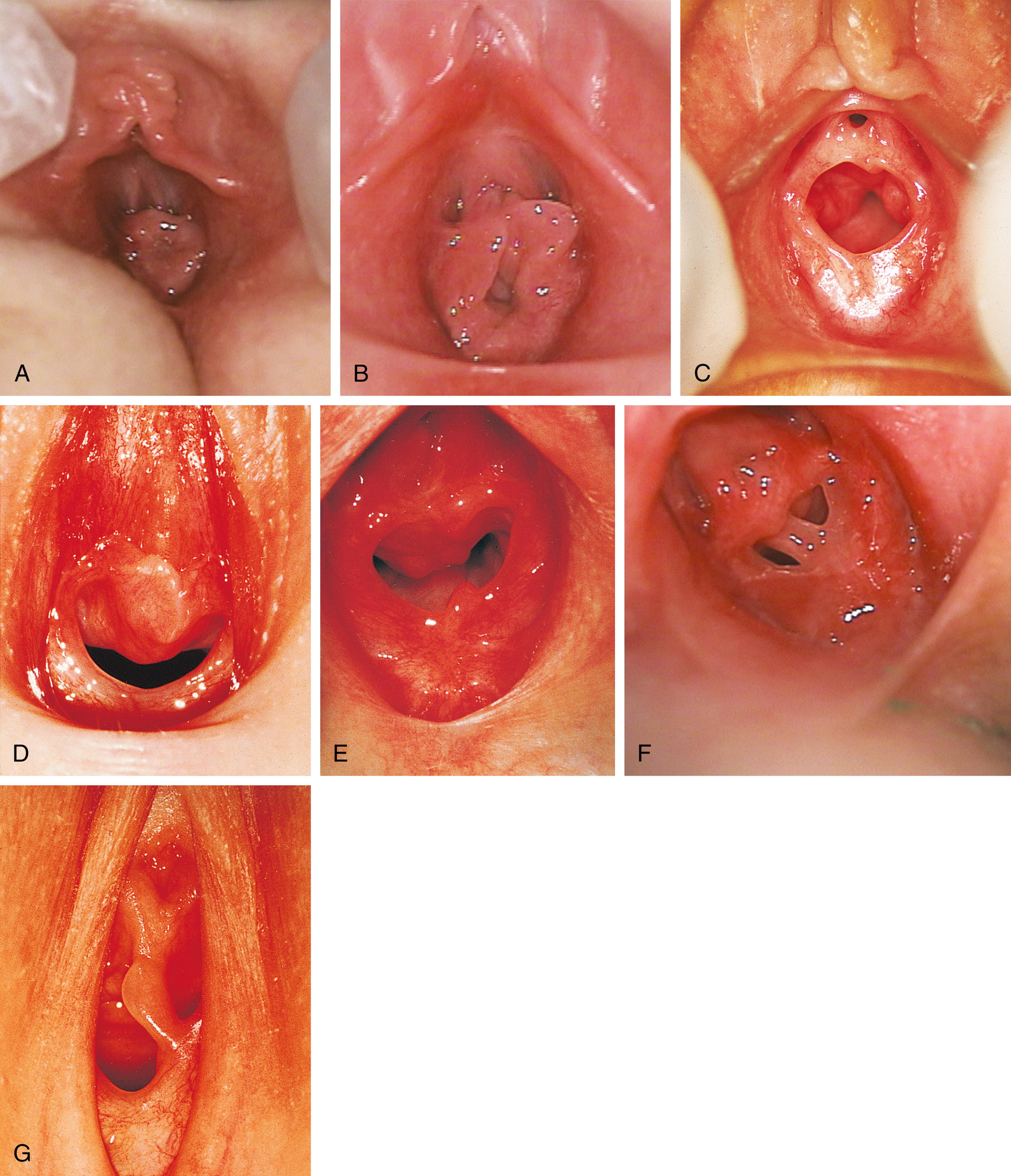 Fig. 19.3, Normal variations in hymenal configuration. (A) In this young infant, the redundant hymen totally obscures the vaginal orifice. (B) In a 23-month-old, the hymenal folds are redundant and the central orifice is visible. (C) Annular orifice of a 2-year-old. Note the thin sharp edges of the hymenal membrane. (D) Crescentic hymenal orifice. (E) Crescentic orifice with septal remnants at 1 and 5 o’clock. (F and G) Two variations of a septate hymen are seen, one in an infant and another in an older child.