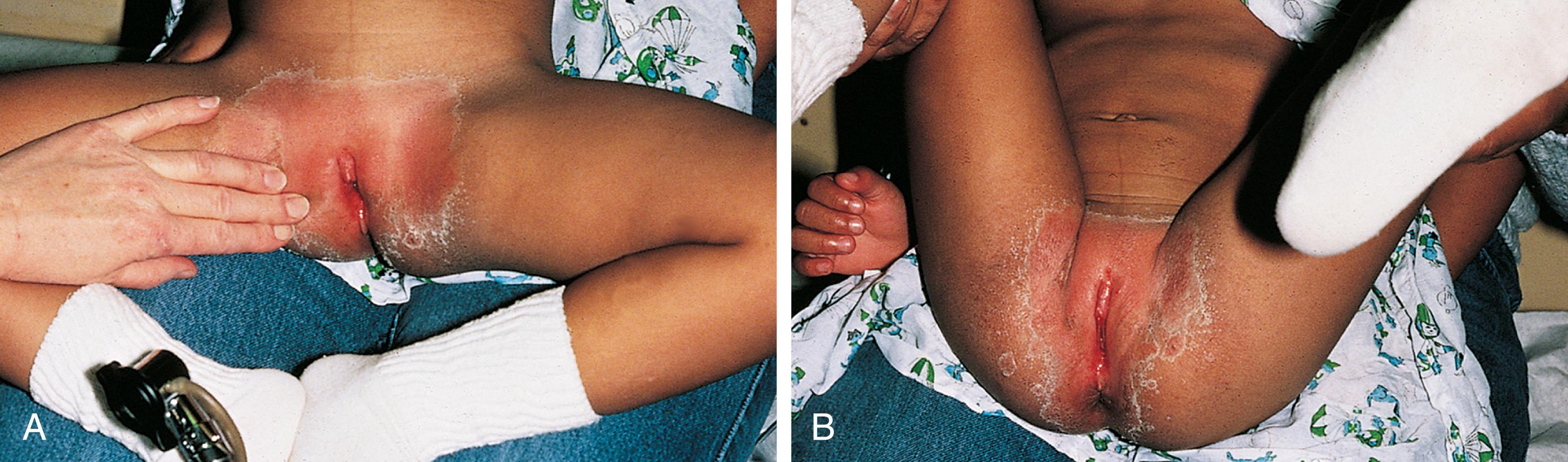 Fig. 19.5, Optimal positions for perineal inspection of the young prepubertal patient. This patient has skin desquamation subsequent to a streptococcal infection. (A) Frog-leg position on the mother’s lap. (B) Lithotomy position on the mother’s lap.