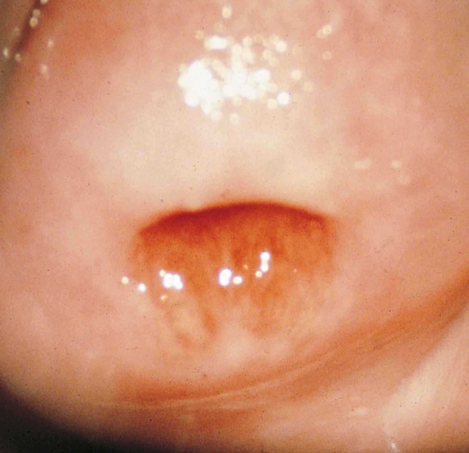 Fig. 19.8, Normal nulliparous cervix. The surface is covered with pink squamous epithelium that is uniform in consistency. The os is small and round. A small area of ectropion is visible inferior to the os.
