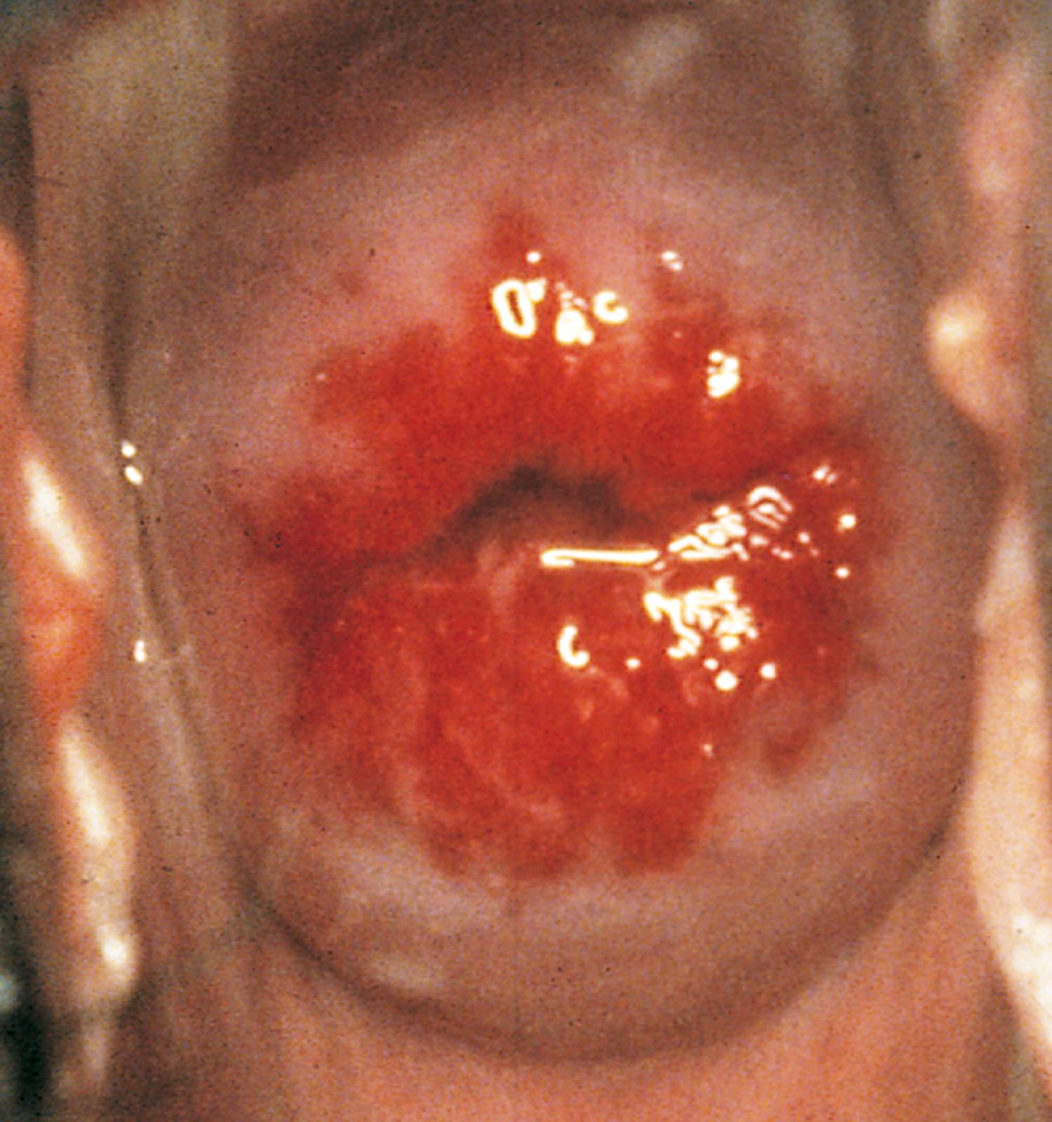 Fig. 19.9, Ectropion. Columnar mucosal cells usually found in the endocervical canal have extended out onto the surface of the cervix, creating a circular raised erythematous appearance. Note the normal nonpurulent cervical mucus. This normal variant is not to be confused with cervicitis.