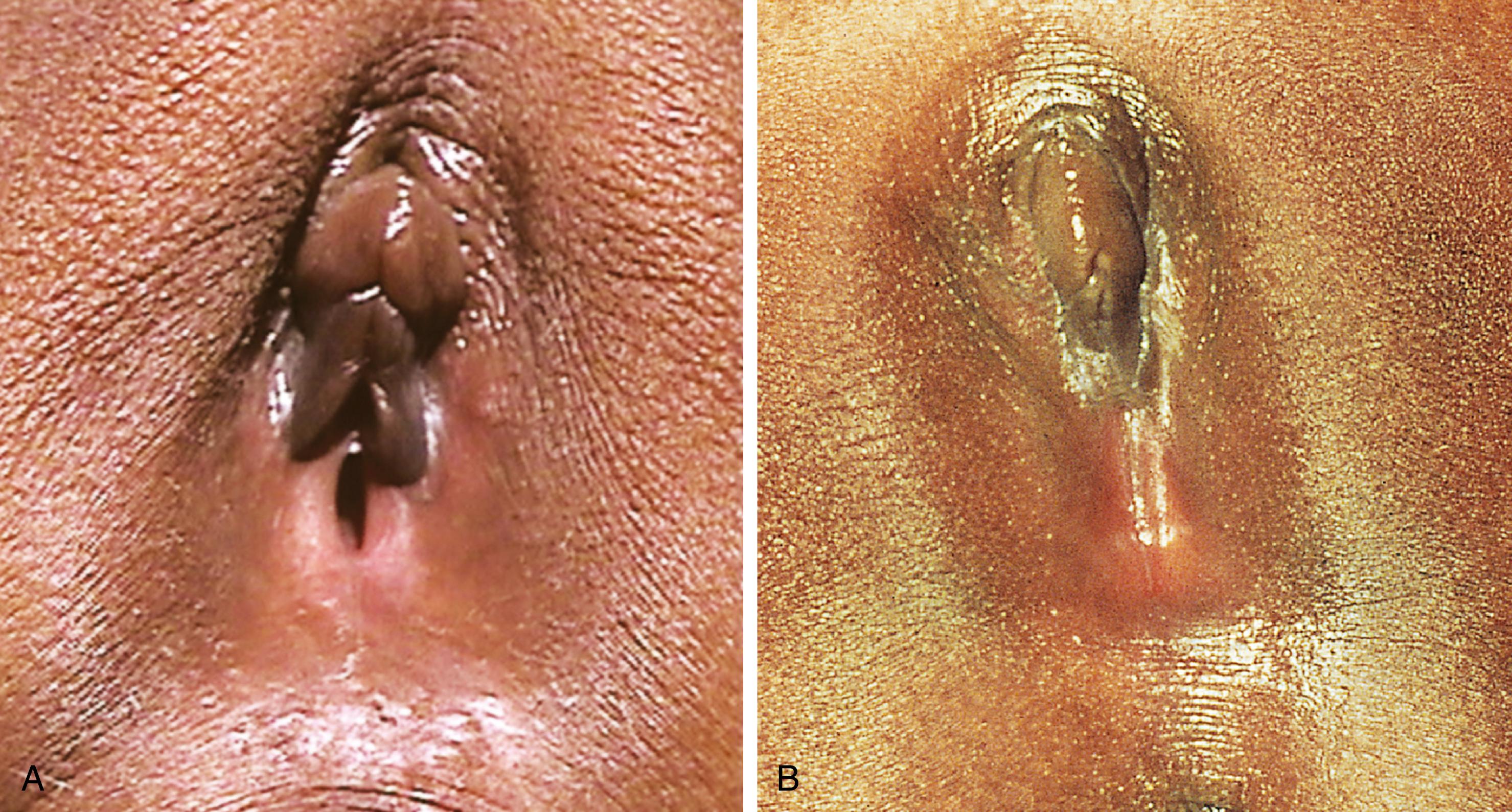 Fig. 19.10, Labial adhesions. Agglutination and adhesion of the labia minora, as a result of healing after inflammation, produce the appearance of a smooth flat surface overlying the introitus, divided centrally by a thin lucent line. (A) In this infant, the fused portion involves the posterior half of the introitus. (B) In another, the fused area has extended much further anteriorly.