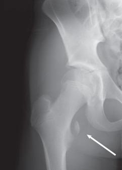 Fig. 136.1, Avulsion fracture of the lesser tuberosity in a skeletally immature patient. The white arrow denotes the site of avulsion.