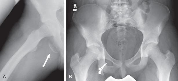 Fig. 136.2, (A) Avulsion fracture of the ischial tuberosity. The white arrow denotes a large fragment of ischium. (B) The same patient after open reduction and internal fixation