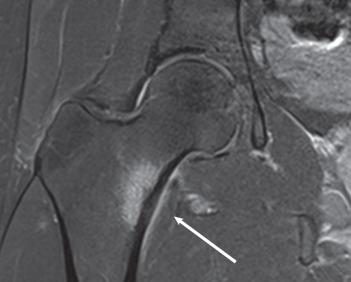 Fig. 136.3, Magnetic resonance image of a stress fracture of the intertrochanteric region of the hip in an adolescent female. The white arrow denotes an area of edema due to the stress fracture.