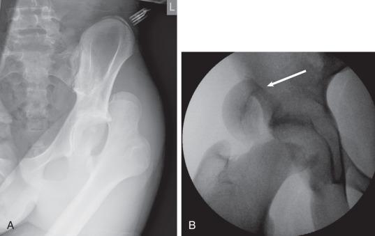 Fig. 136.4, (A) Posterior dislocation of the hip in a skeletally immature patient. (B) Epiphysiolysis during reduction of a dislocated hip. Open reduction and internal fixation of the epiphysis was necessary