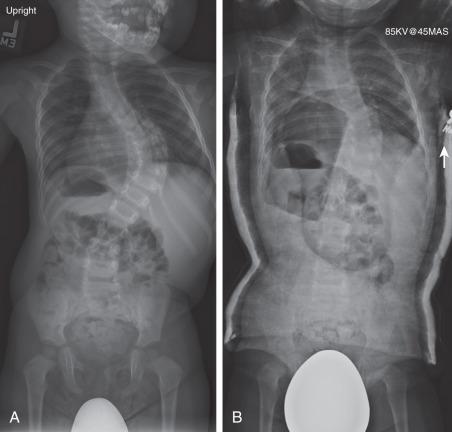 Figure 37.2, (A) A 14-month-old child presenting with a 70-degree right thoracic curvature. (B) Significant improvement in standing film in Mehta cast. Long-term results of this technique in large magnitude curves are unpredictable, although this serves as an effective delay tactic.