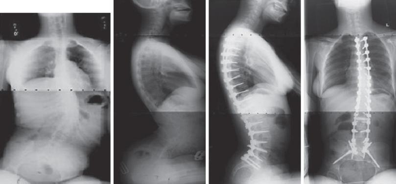 Figure 37.3, Patient with neuromuscular scoliosis preoperatively and following posterior spinal fusion from T3 to the sacrum with pedicle screw instrumentation.