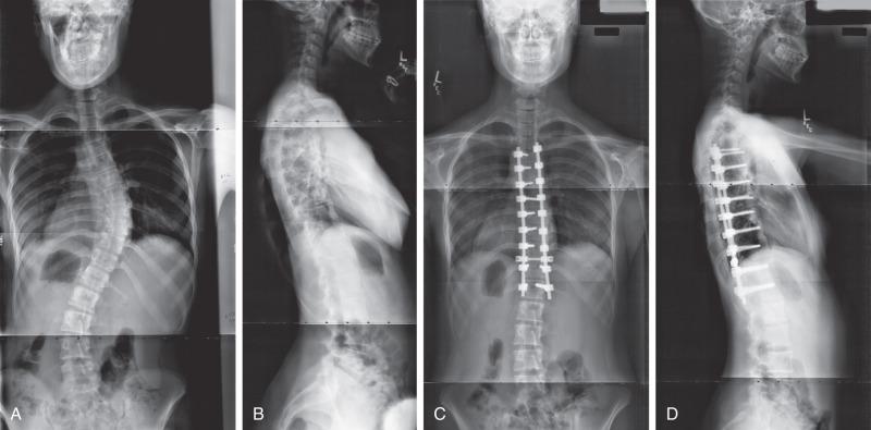 Figure 37.4, (A) Posteroanterior (PA) standing scoliosis film in a patient with adolescent idiopathic scoliosis. (B) Lateral spine film reveals hypokyphosis over the region of the curvature. (C) Postoperative PA and (D) lateral views following pedicle screw fixation.