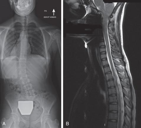 Figure 37.5, Scoliosis with a syrinx. (A) Posteroanterior (PA) scoliosis film of a female patient presenting with deformity, back pain, and headaches. (B) Magnetic resonance (MR) image of the spine reveals a syrinx and Chiari malformation.