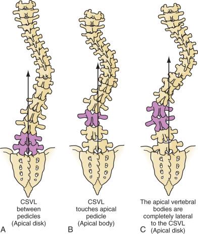 Figure 37.6, Lumbar modifier for the Lenke classification. The lumbar modifier is determined by the relationship of the pedicles in the lumbar curve to the central sacral vertebral line (CSVL).