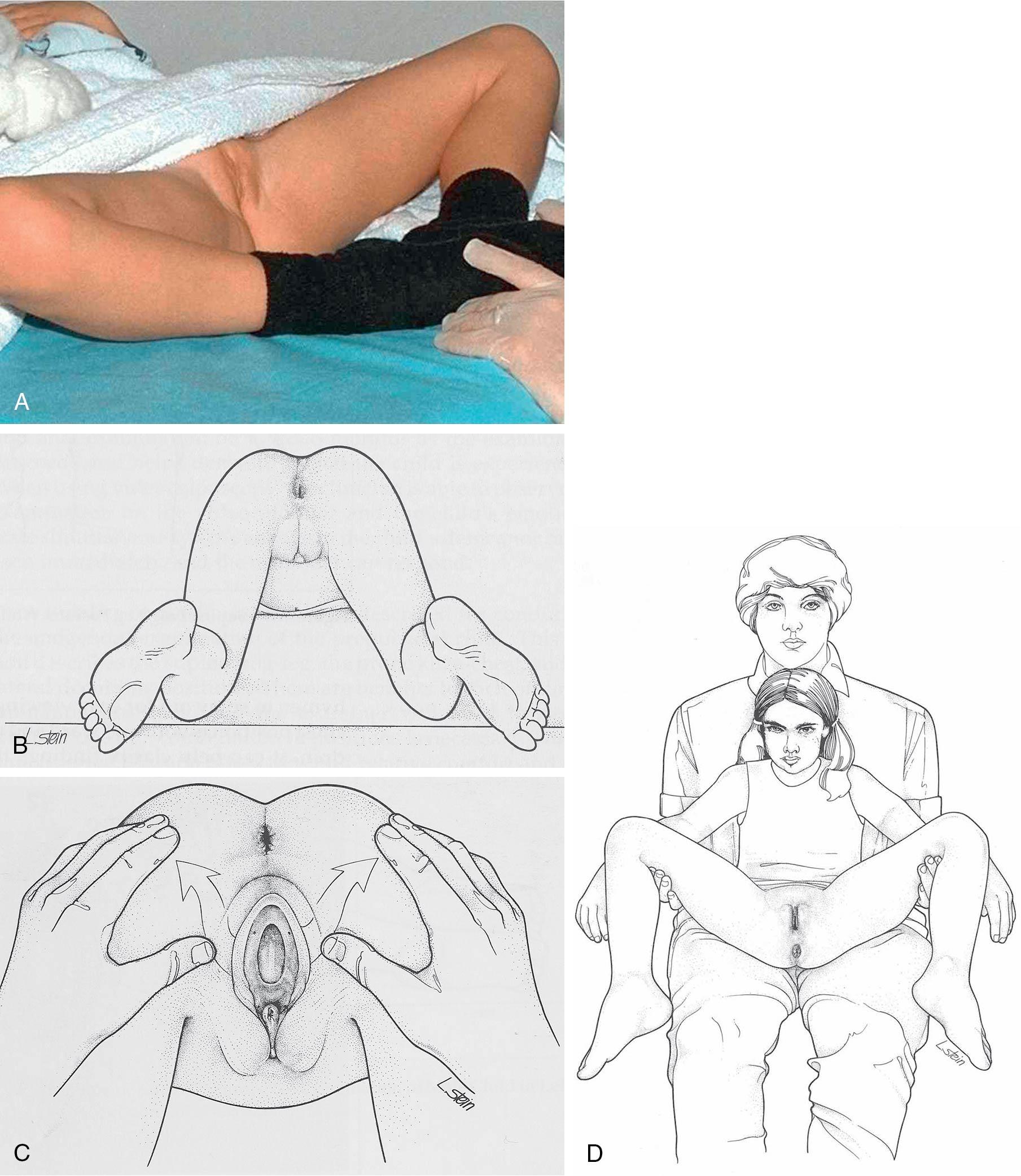 Fig. 12.1, Different positions for performing a gynecologic examination on a child. A, Frog leg position. B, Knee-chest position. C, Prone position. D, Sitting on mom’s lap.
