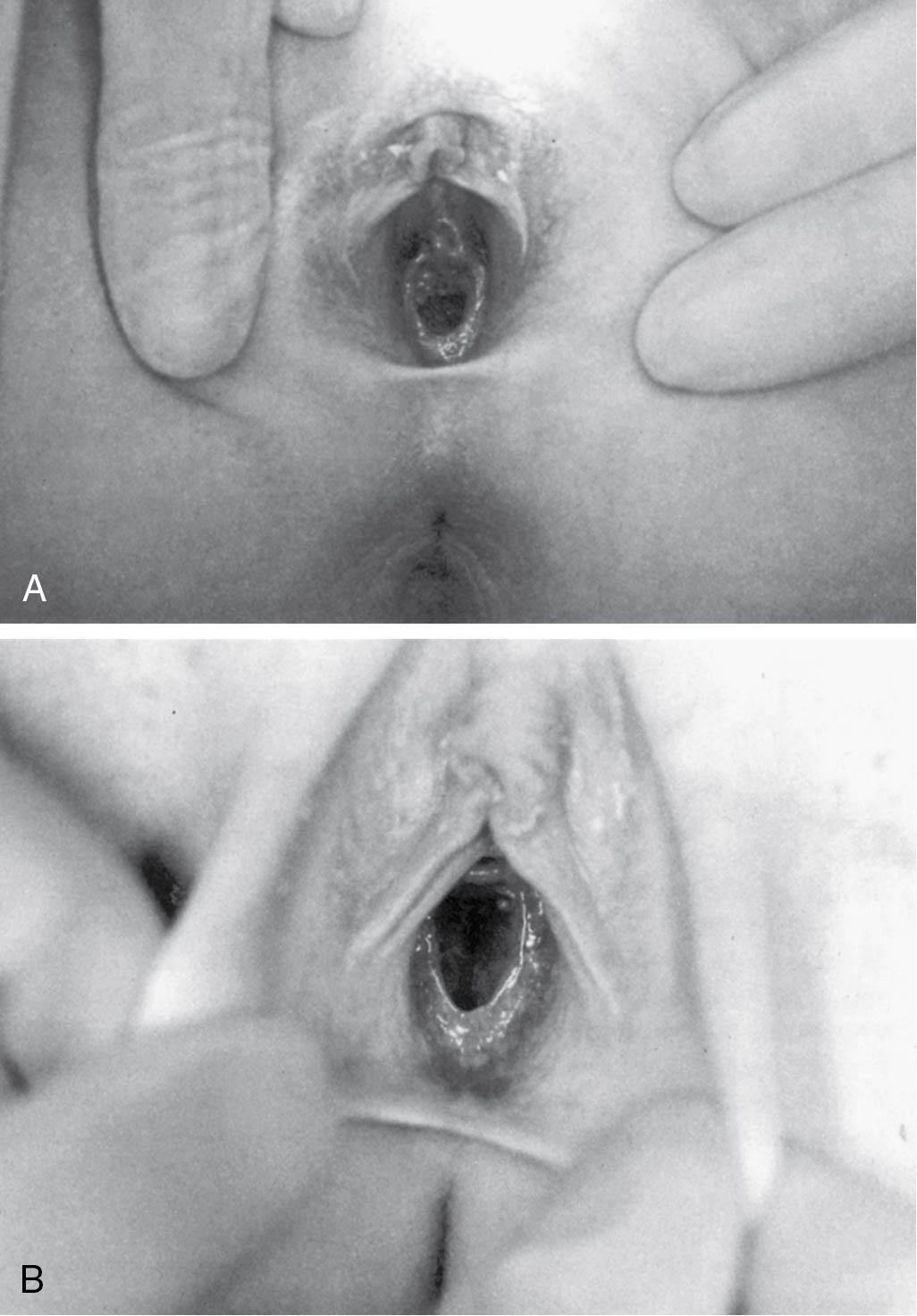 Fig. 12.2, Examination of the vulva, hymen, and anterior vagina by gentle lateral retraction ( A ) and gentle gripping of the labia and pulling anteriorly ( B ).