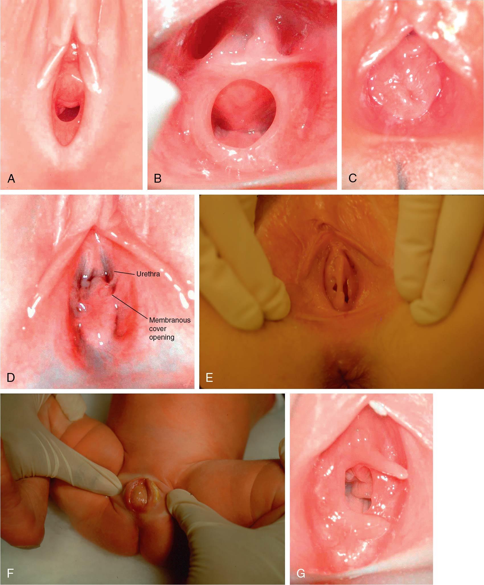 Fig. 12.3, Types of hymens. A, Crescentic. B, Annular. C, Redundant. D, Microperforate. E, Septated. F, Imperforate. G, Hymeneal tags.