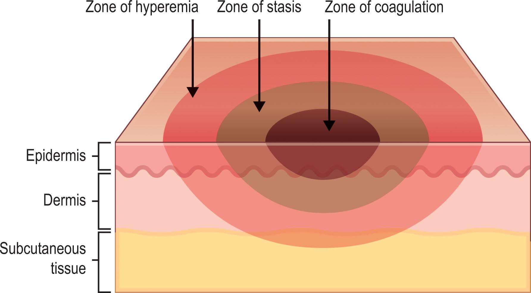 Figure 21.1, Jackson zones of burn injury.