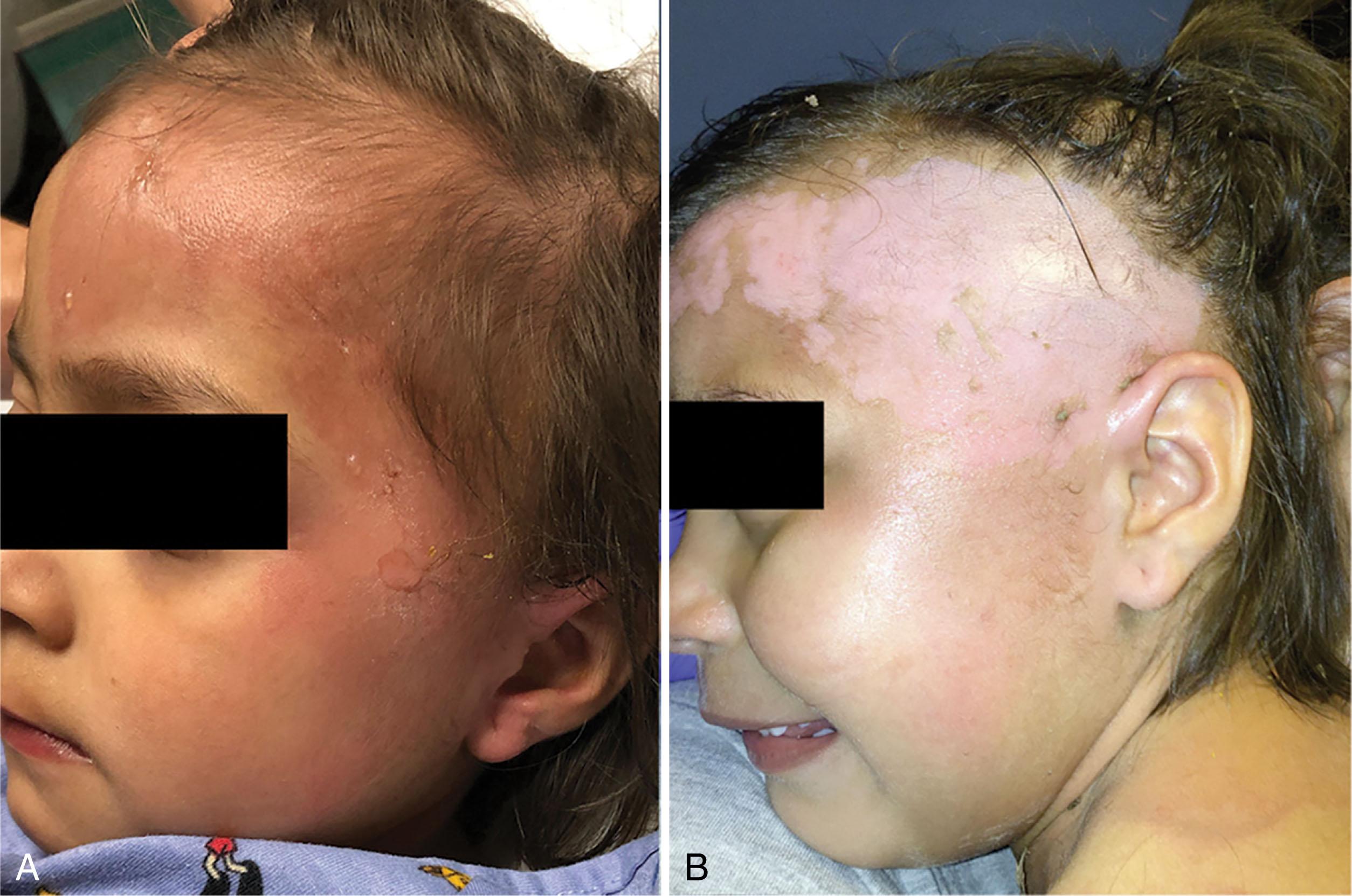 Figure 21.2, Cleansing and exposing the burn wound. Prior to assessment (A) the extent of skin injury can be underestimated, particularly in burns that extend into the hairline (B) .