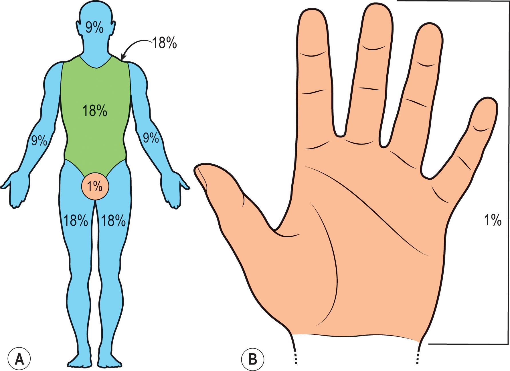 Figure 21.4, (A) Rule of Nines diagram. ( B) Palmar method diagram.