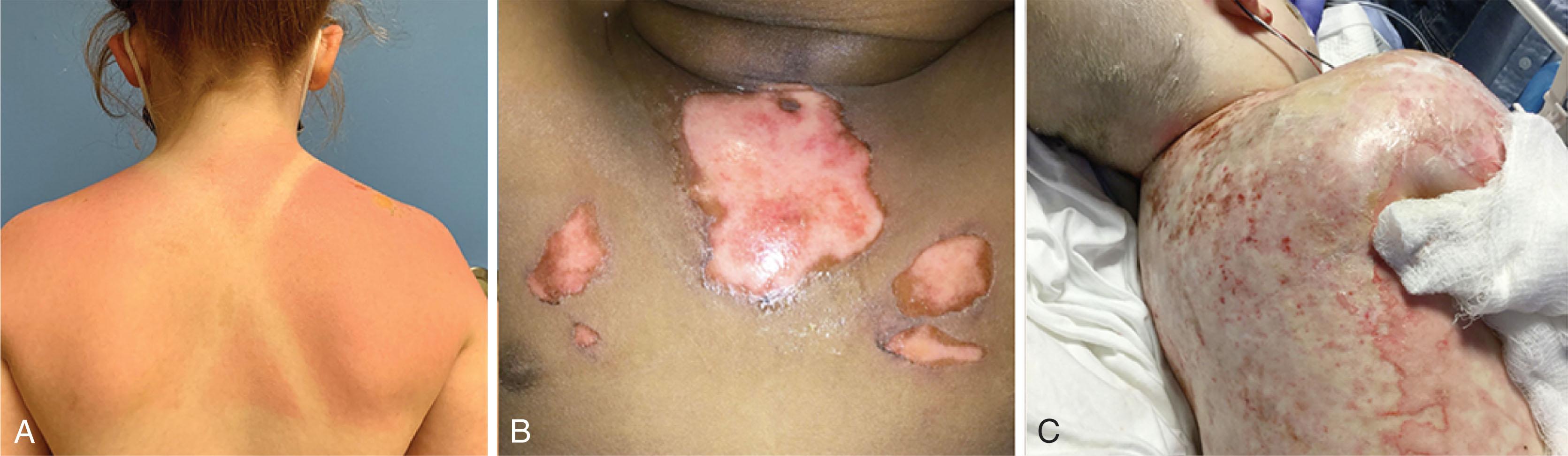 Figure 21.5, Classifying burn depth. (A) Superficial (first degree) burn injury. (B) Partial-thickness (second degree) burn injury. (C) Full-thickness (third degree) burn injury.