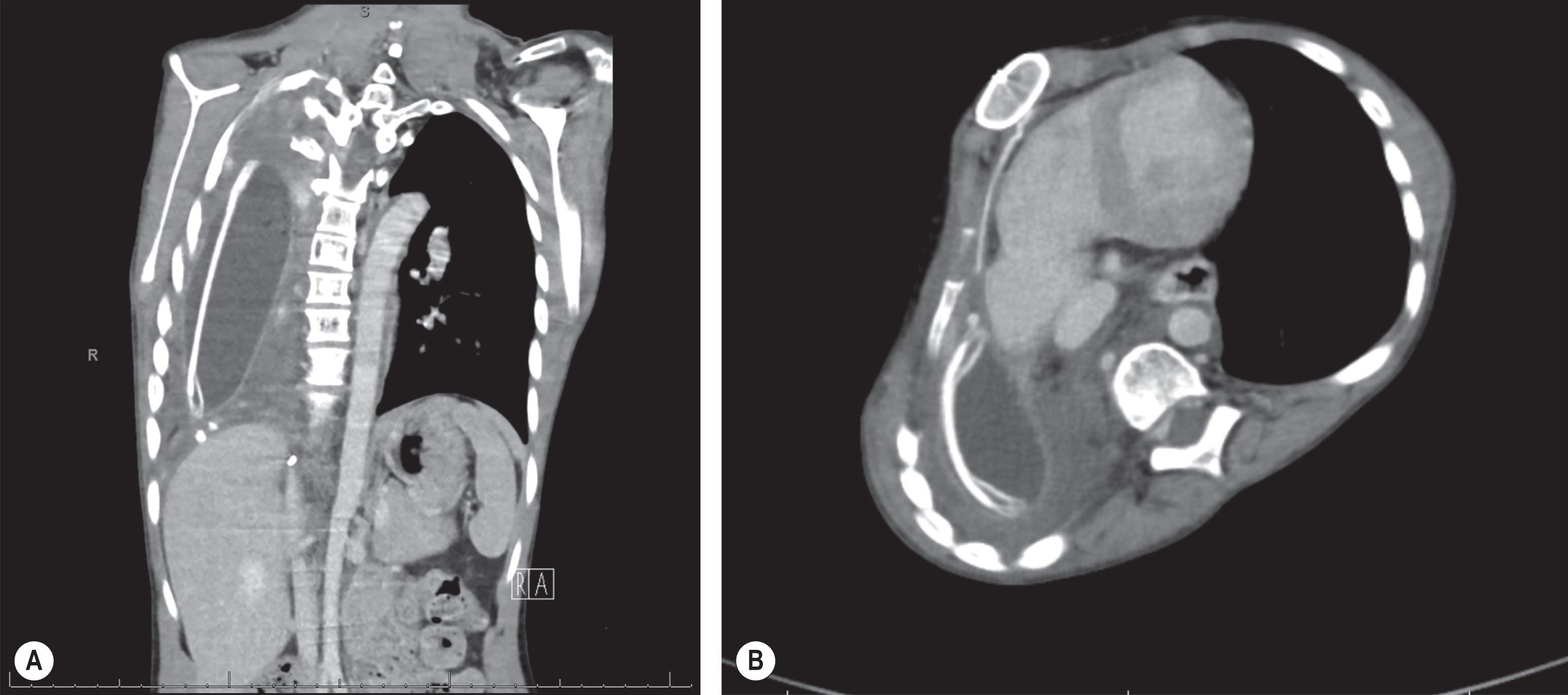 Figure 32.2, (A,B) Computerized tomography showing placement of tissue expander into right hemithorax following pneumonectomy in a 12-year-old female.