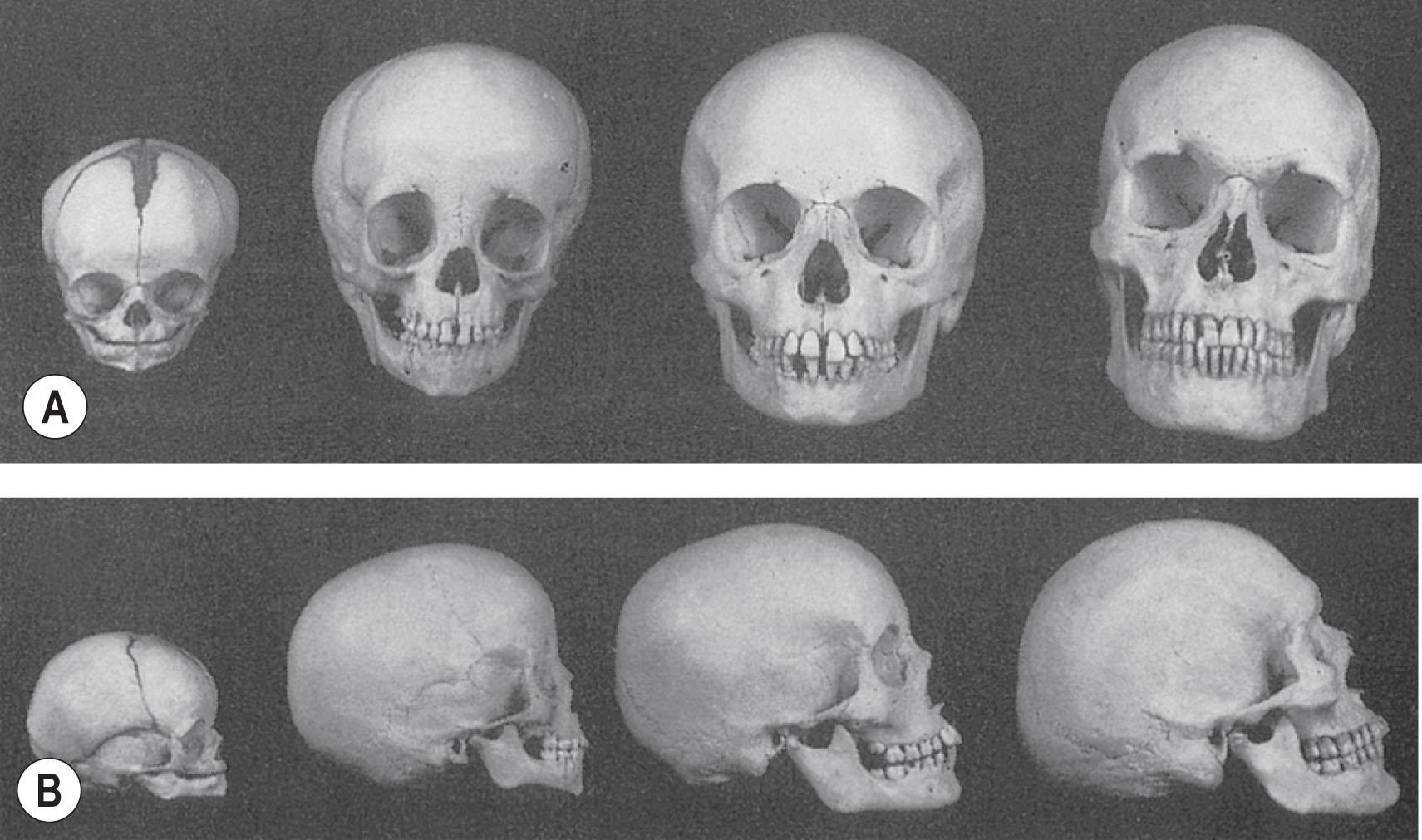 Figure 22.1, (A) Frontal view and (B) side view of the growing craniofacial skeleton. Note the decreasing cranial-to-facial ratio and increasing facial prominence.