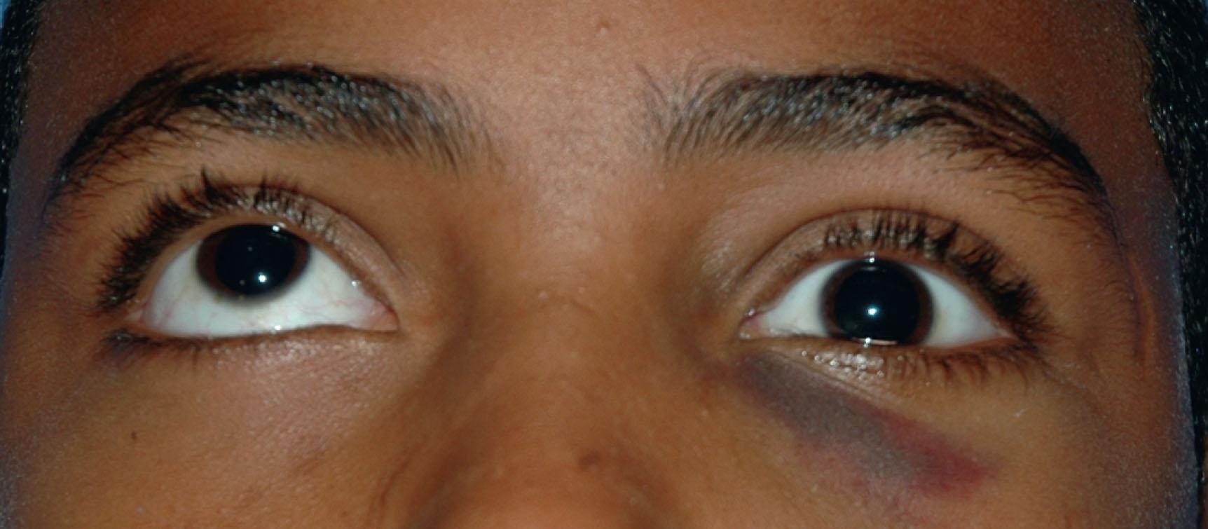 Figure 22.12, Patient with an entrapped left inferior rectus. He is being instructed to “look up”, but is unable to do so with his left eye due to the entrapped inferior rectus.