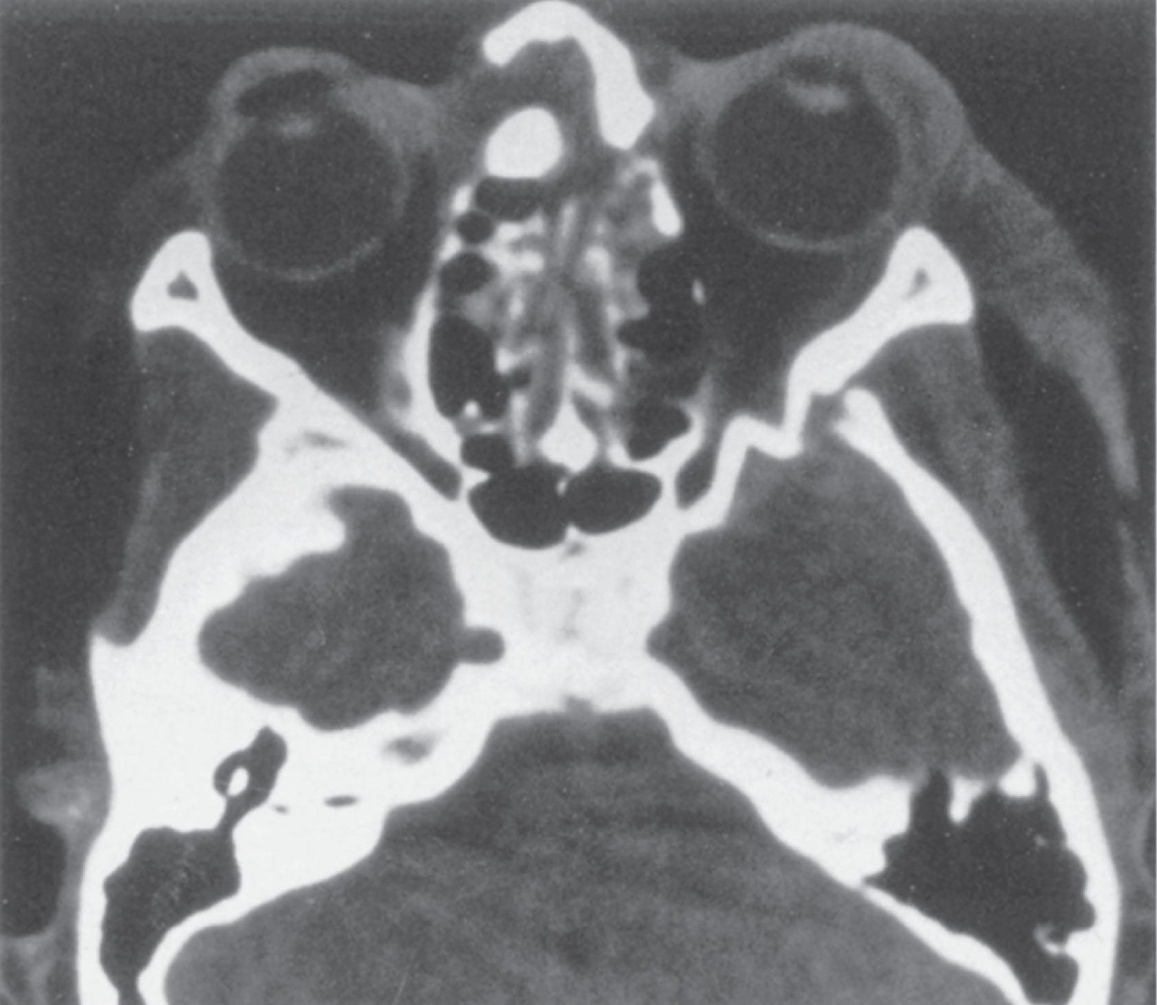 Figure 22.13, Superior orbital fissure (SOF) syndrome may well result from the injury demonstrated in this axial computed tomography scan, in which a left frontal–temporal–orbital fracture has collapsed the SOF.