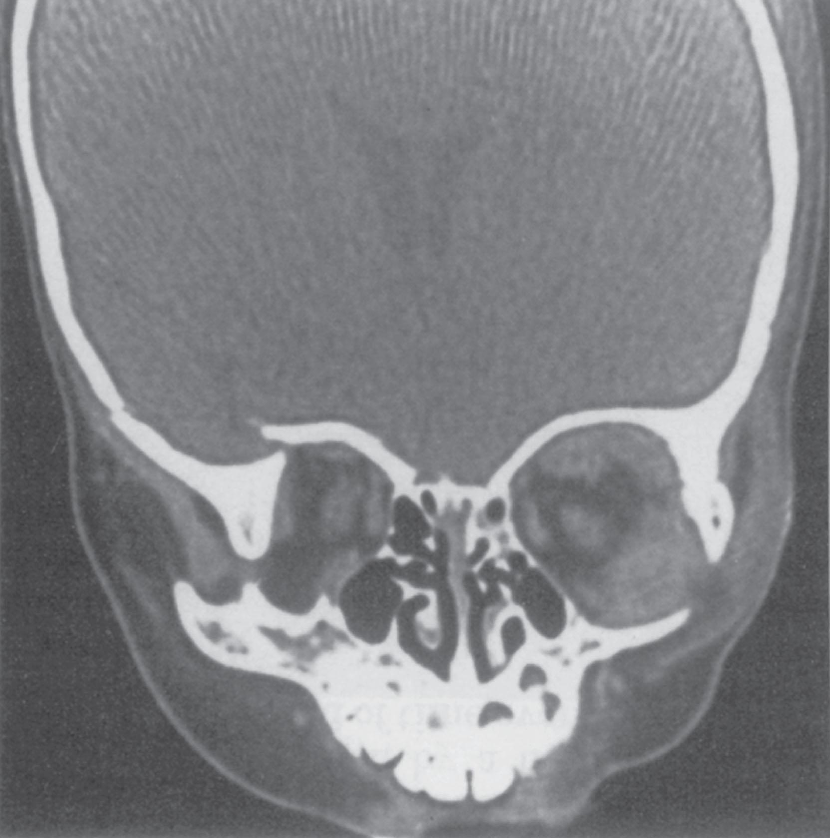 Figure 22.14, Coronal computed tomography scan demonstrating a right frontal–temporal–orbital fracture. The lateral orbital wall is compressed medially, decreasing orbital volume and resulting in exophthalmos.