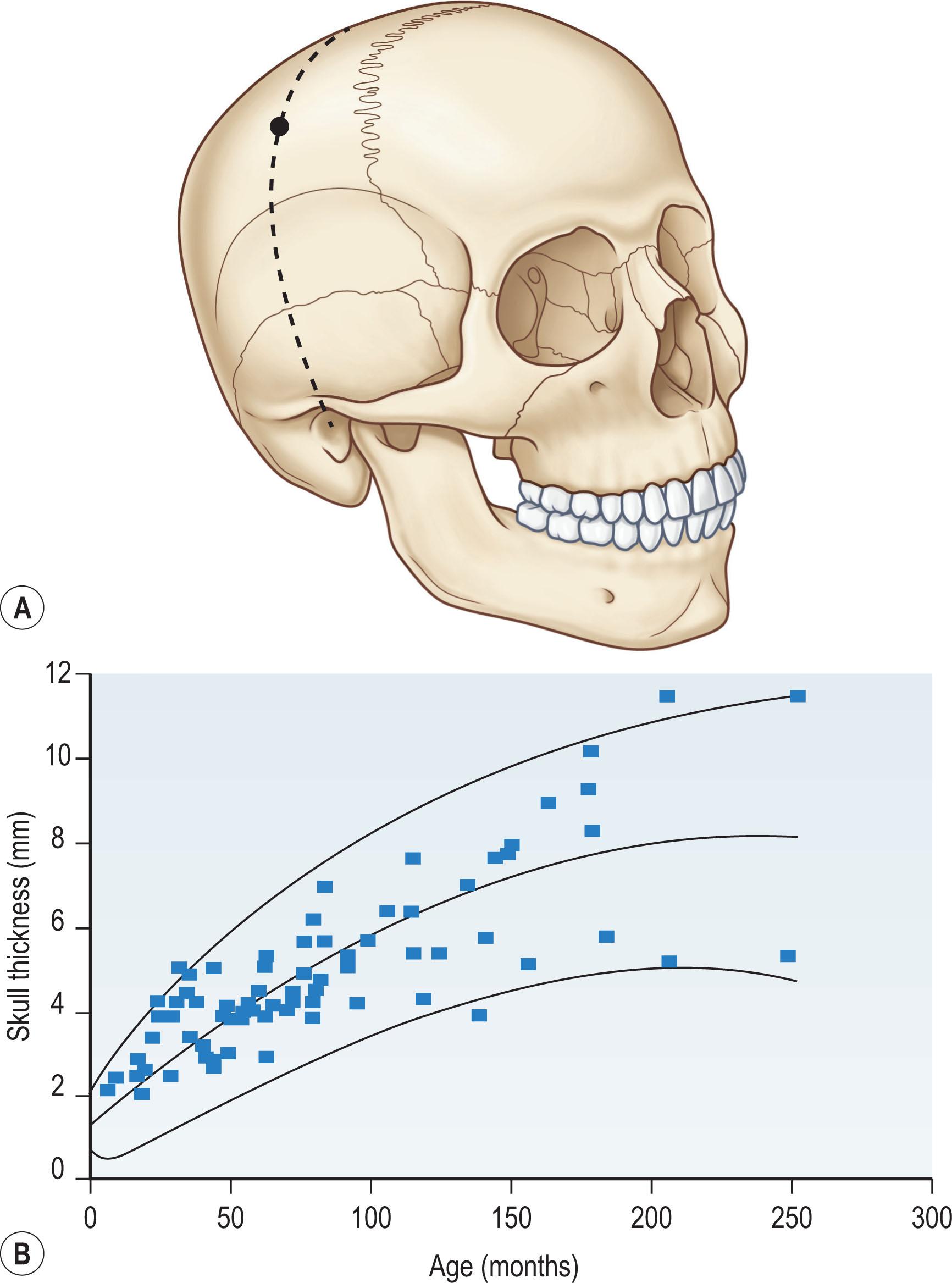 Figure 22.15, (A,B) The skull increases in thickness with craniofacial development in a relationship reported by Pensler and McCarthy.