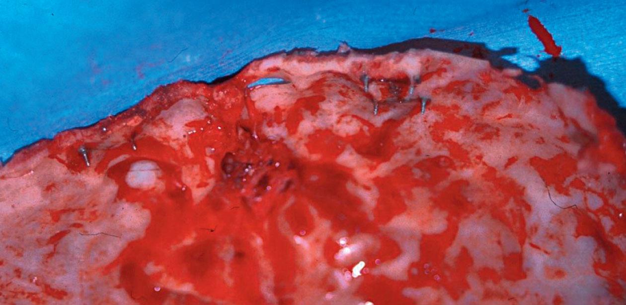 Figure 22.16, Endocranial surface of a calvarial bone flap demonstrating transcranial migration of metallic hardware in a pediatric patient.