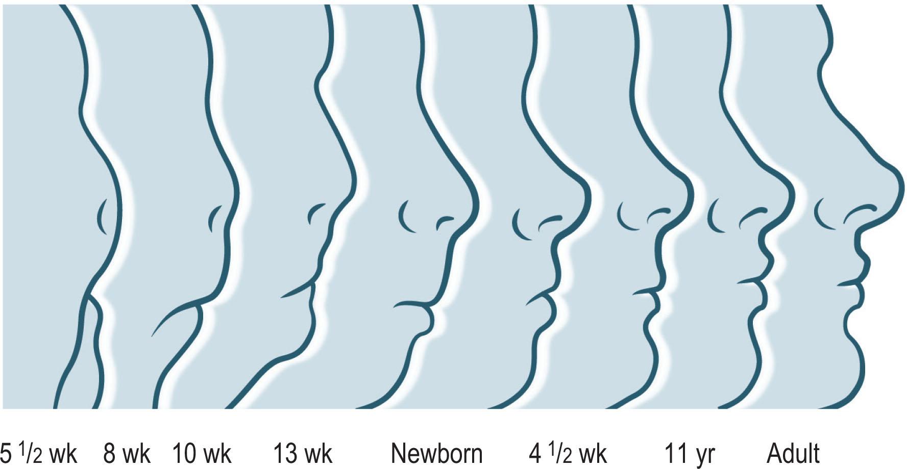 Figure 22.2, Schematic of growing face, in profile. Note decreased protection of face afforded by cranium and increasing prominence (and exposure to injury) of mandible.