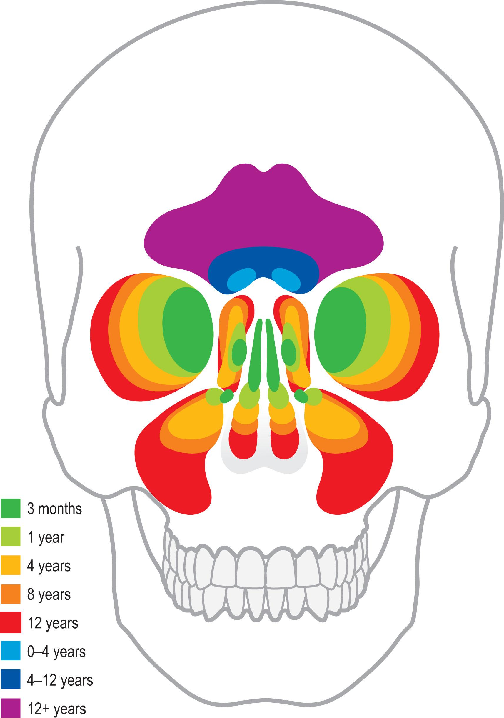 Figure 22.3, Pneumatization of the sinuses. Fracture patterns evolve with sinus development.