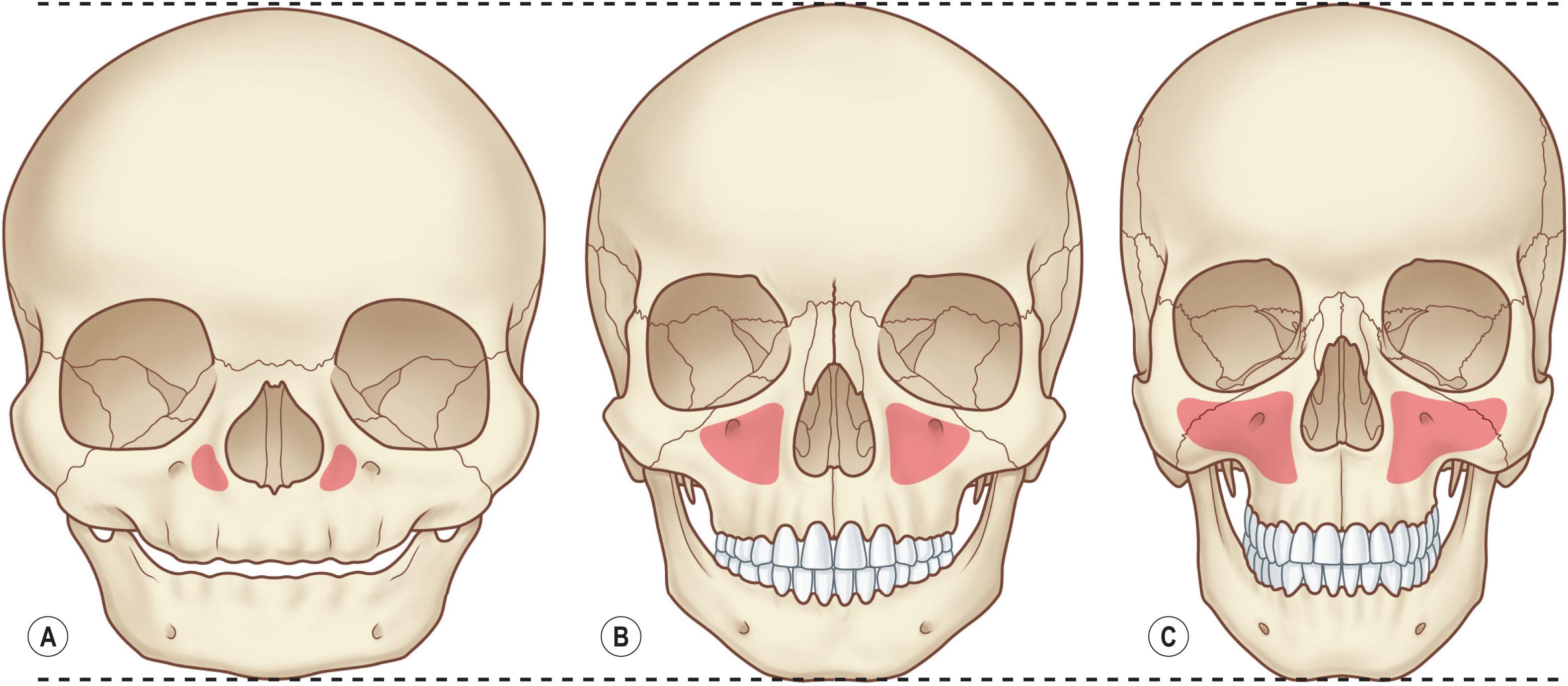 Figure 22.4, (A–C) Development of the maxillary sinuses. The maxillary sinus plays an important role in determining how traumatic force will be transmitted through the midface.