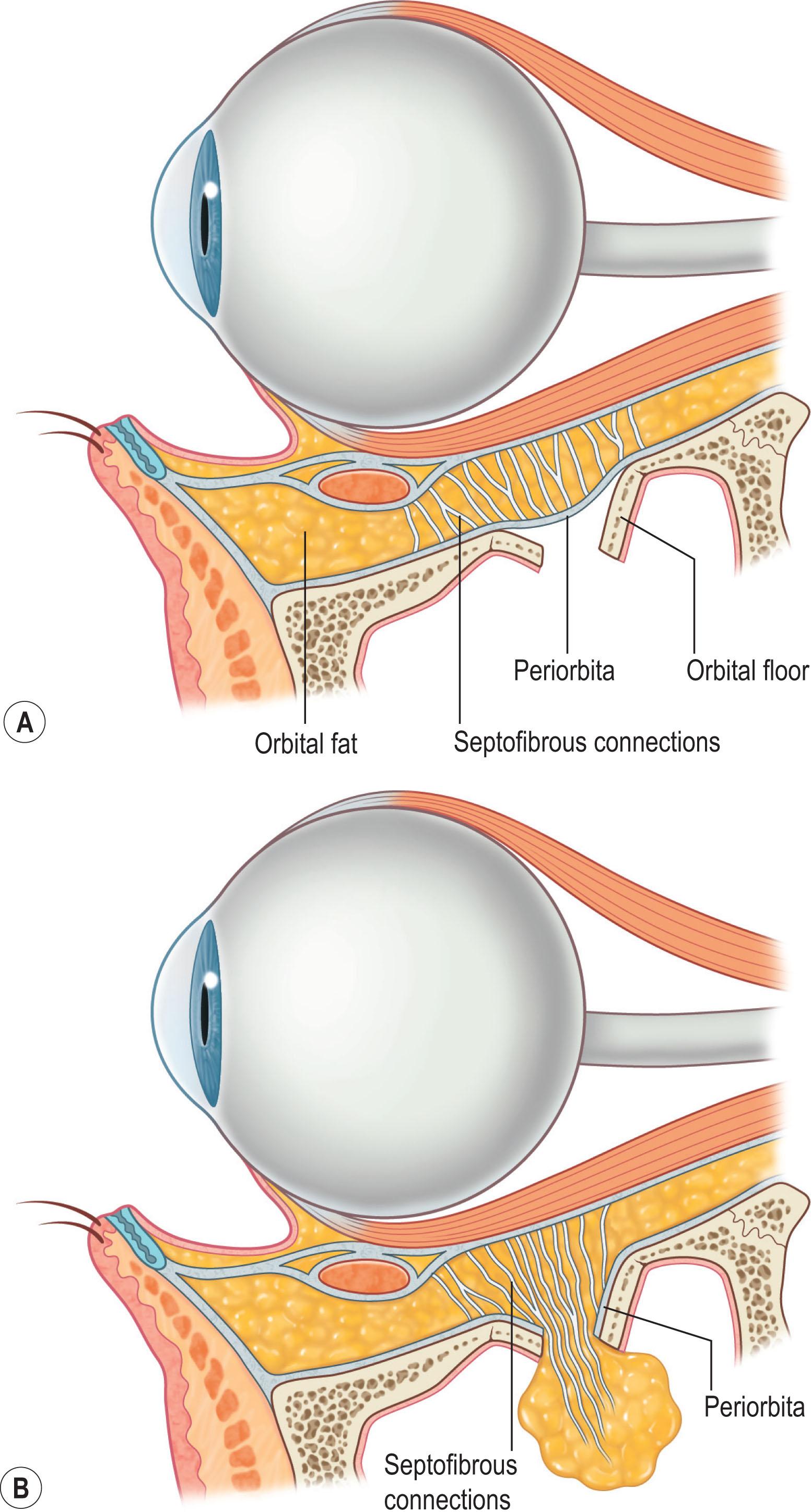 Figure 22.5, Sagittal section of the orbit. (A) Orbital floor fracture with preserved orbital volume secondary to intact periorbita. (B) In contrast, the herniation of orbital contents secondary to disrupted periorbita in association with a floor fracture. It is the injury depicted in (B) that is required for enophthalmos or vertical orbital dystopia.