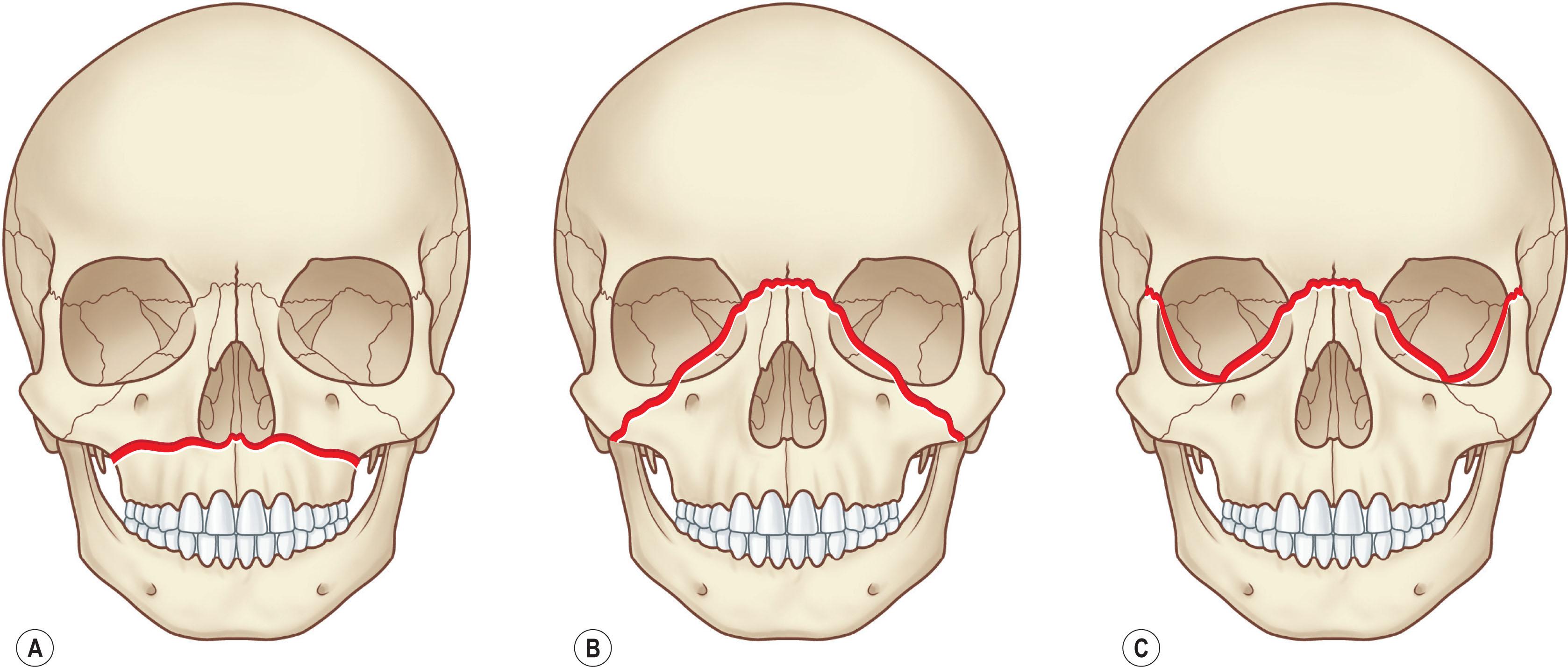 Figure 22.6, These are the classic Le Fort fracture patterns described in adult craniofacial fractures: (A) Le Fort I; (B) Le Fort II; (C) Le Fort III. Children exhibit distinct fracture patterns, as described in the text and demonstrated in Figs. 22.7 and 22.8 .