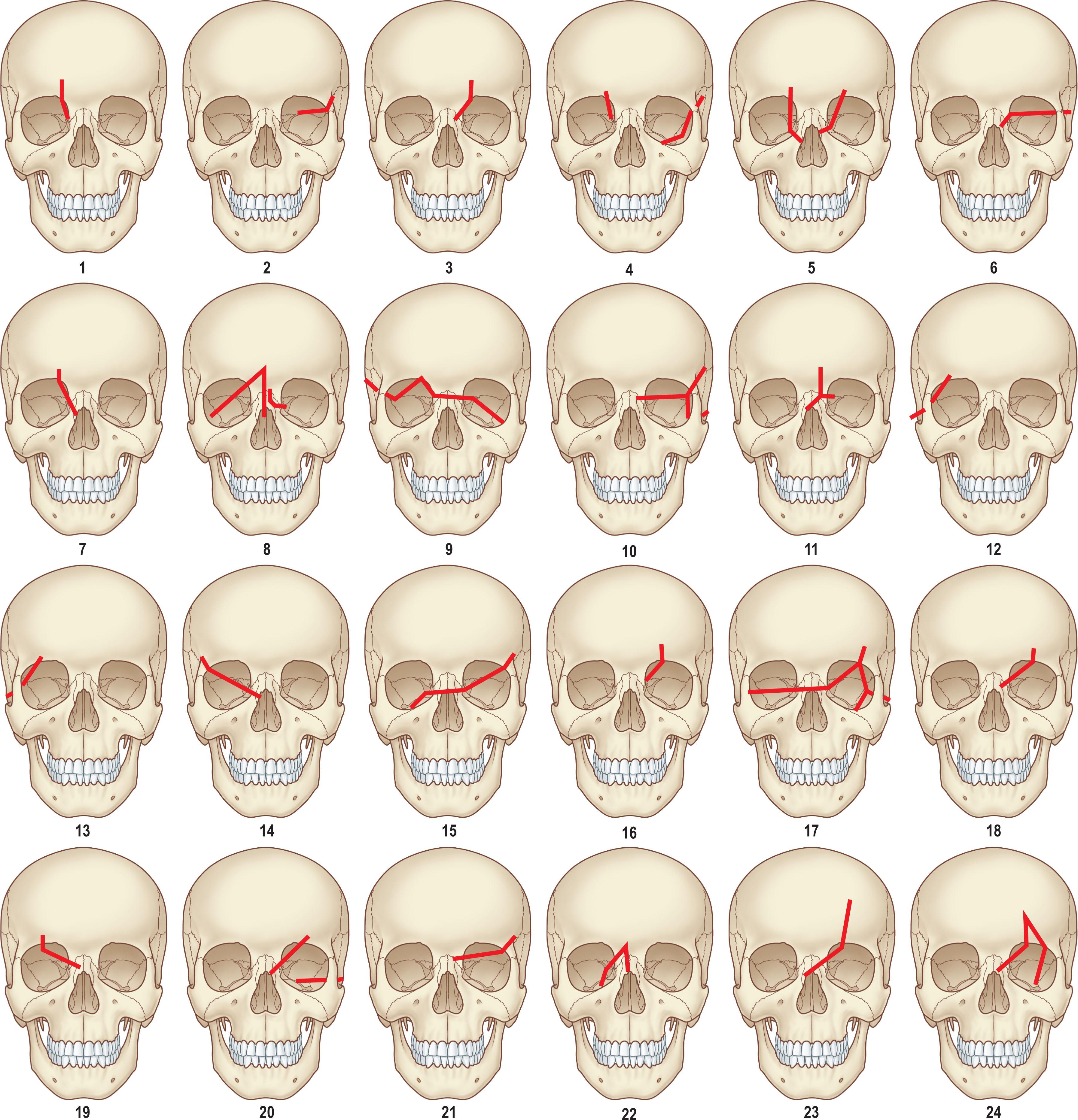 Figure 22.7, Schematic examples of the oblique craniofacial fracture patterns encountered in children.