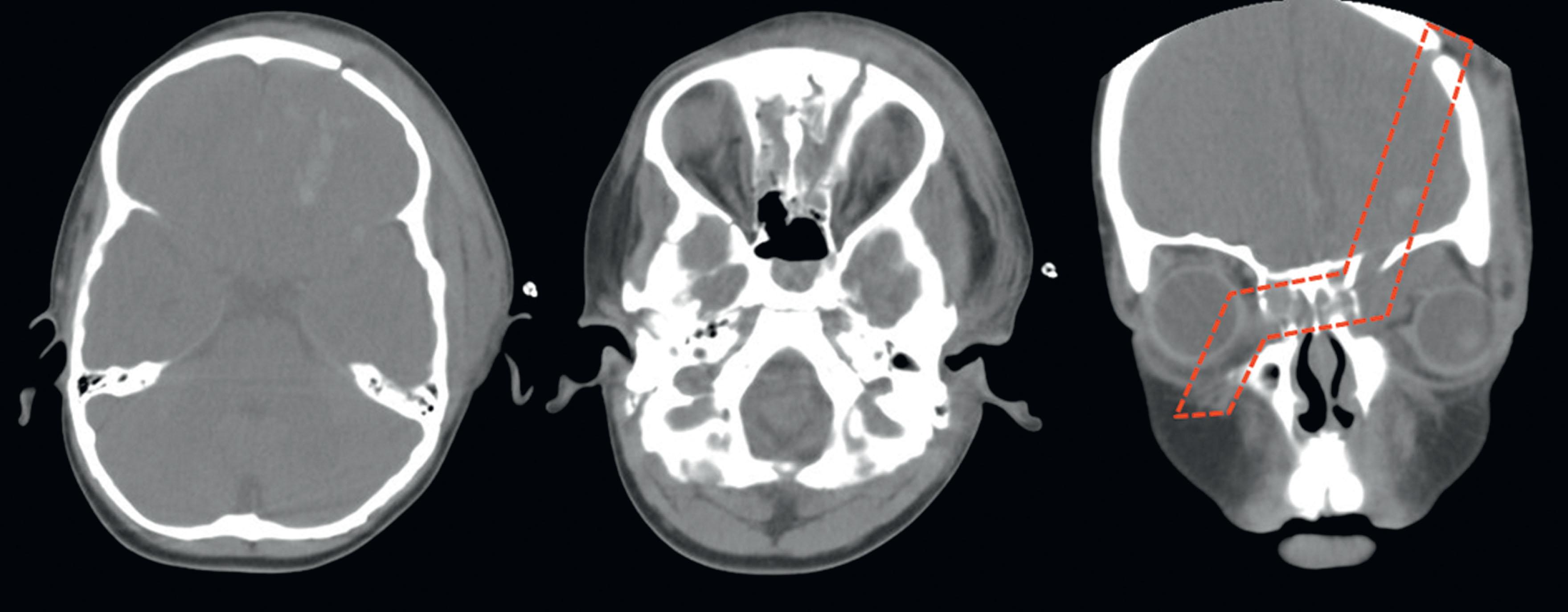 Figure 22.8, Computed tomography (CT) scans in the axial plane demonstrate an oblique fracture at the level of the cranium (left) and cranial base (center). Right, the CT scan represents a sagittal reconstruction of the same patient, with the course of the oblique fracture outlined in red.