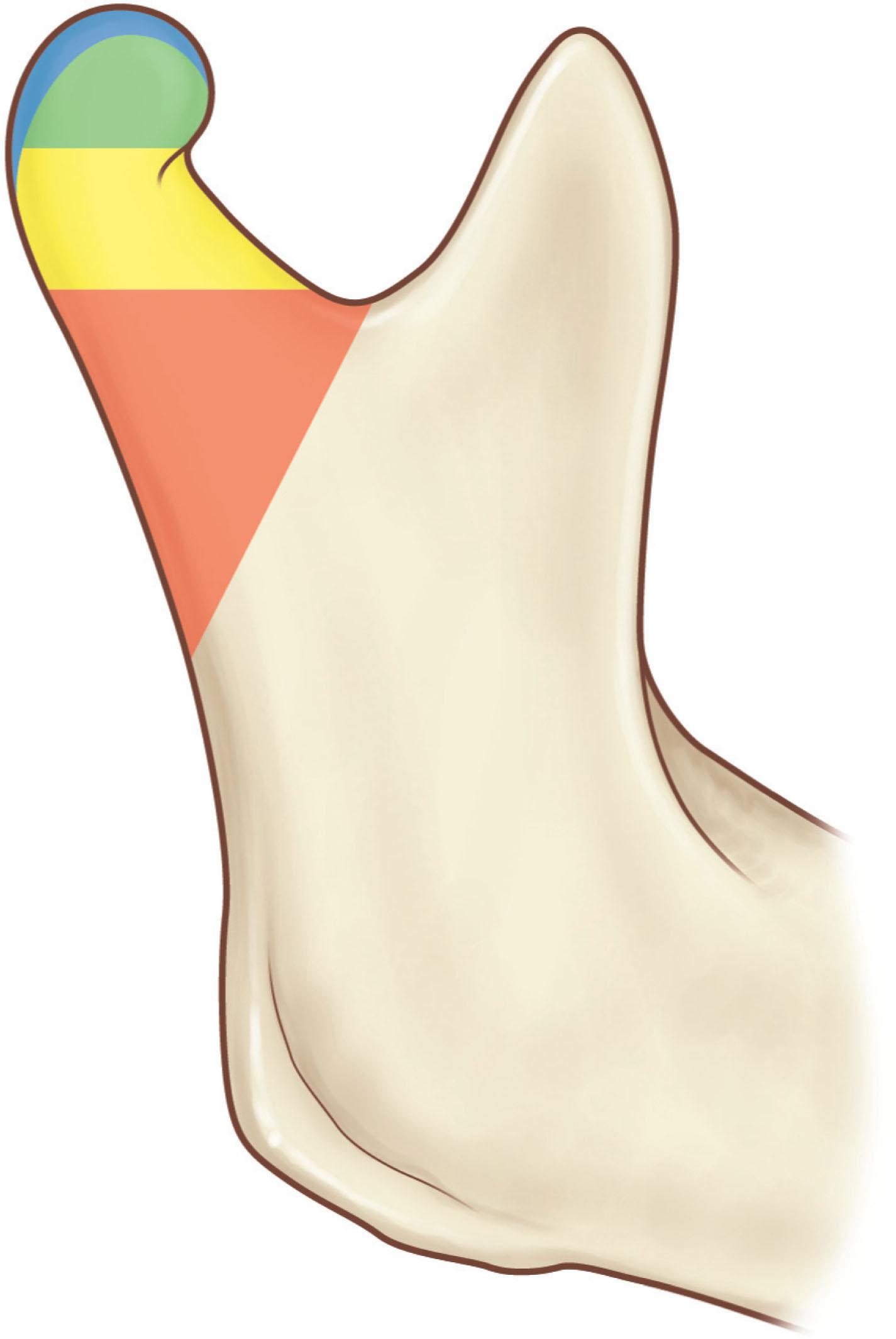 Figure 22.9, Anatomical vocabulary pertaining to the mandibular condyle. The condylar head is green (except its articular surface, which is blue), the condylar neck is yellow, and the subcondylar region is orange. Vague terminology in reference to these structures often causes confusion in the clinic and in the literature.