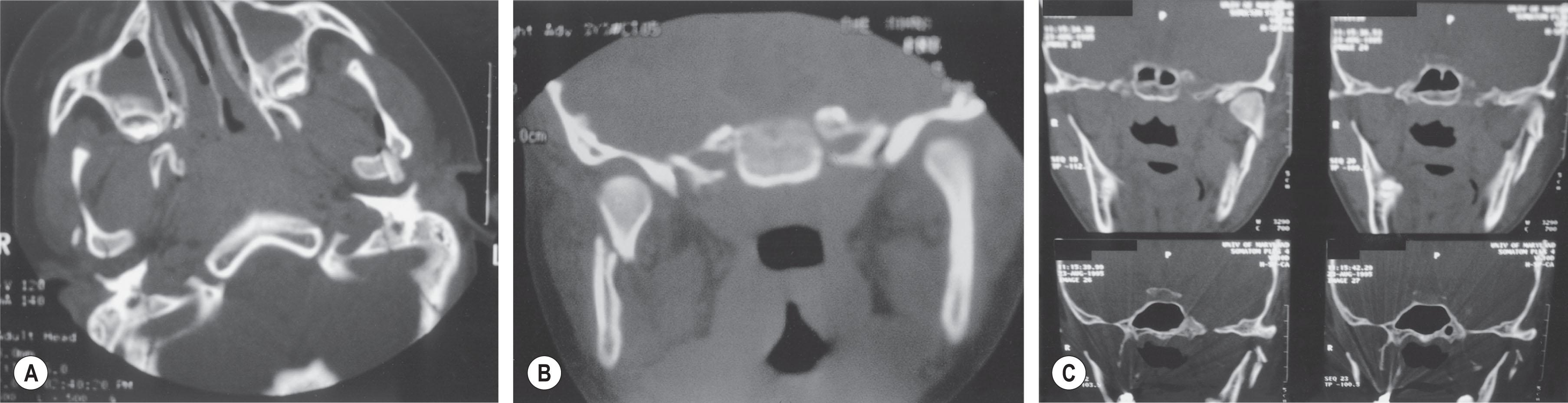 Figure 22.10, (A) Axial computed tomography scan demonstrating condylar head fractures. (B) Coronal view of a condylar neck fracture. (C) Serial coronal views of a subcondylar fracture.