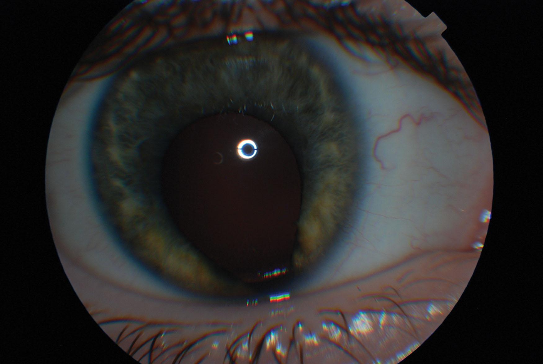 Fig. 37.2, Coloboma of the right iris.